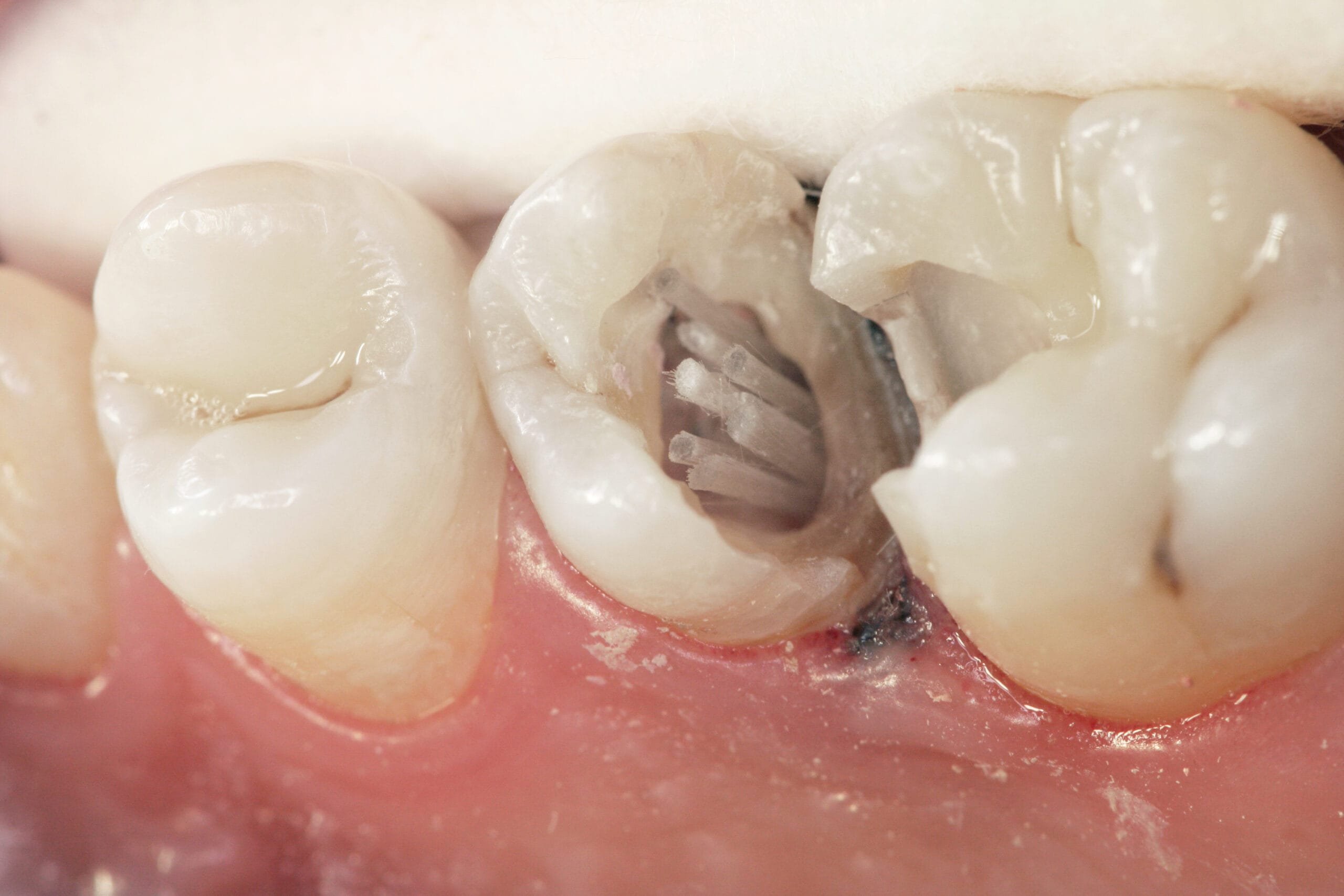 Dentapreg® PINPost fiber post placed inside a prepared tooth canal