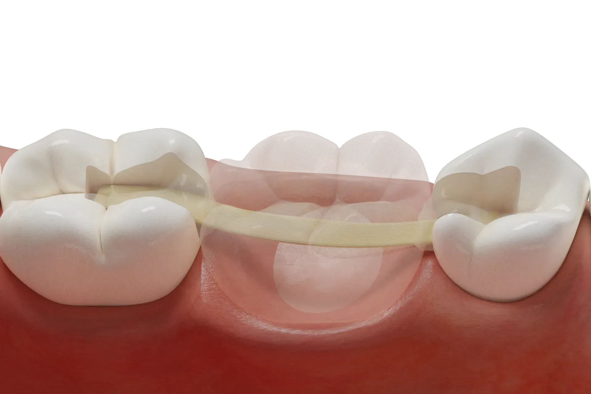 Adhesive dental bridge