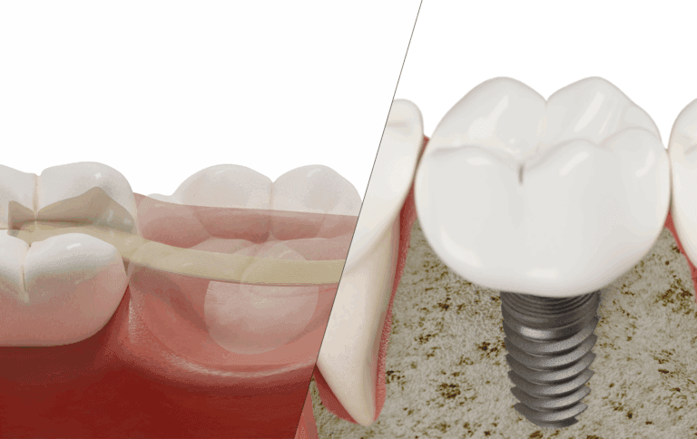 Dental bridge compared with implant