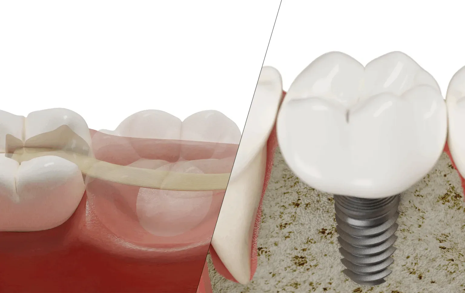 Zahnbrücke oder Implantat: Was ist das Richtige für Sie?