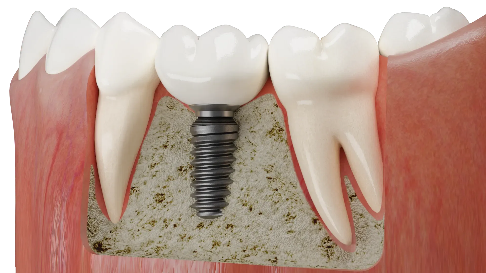 Dental implant