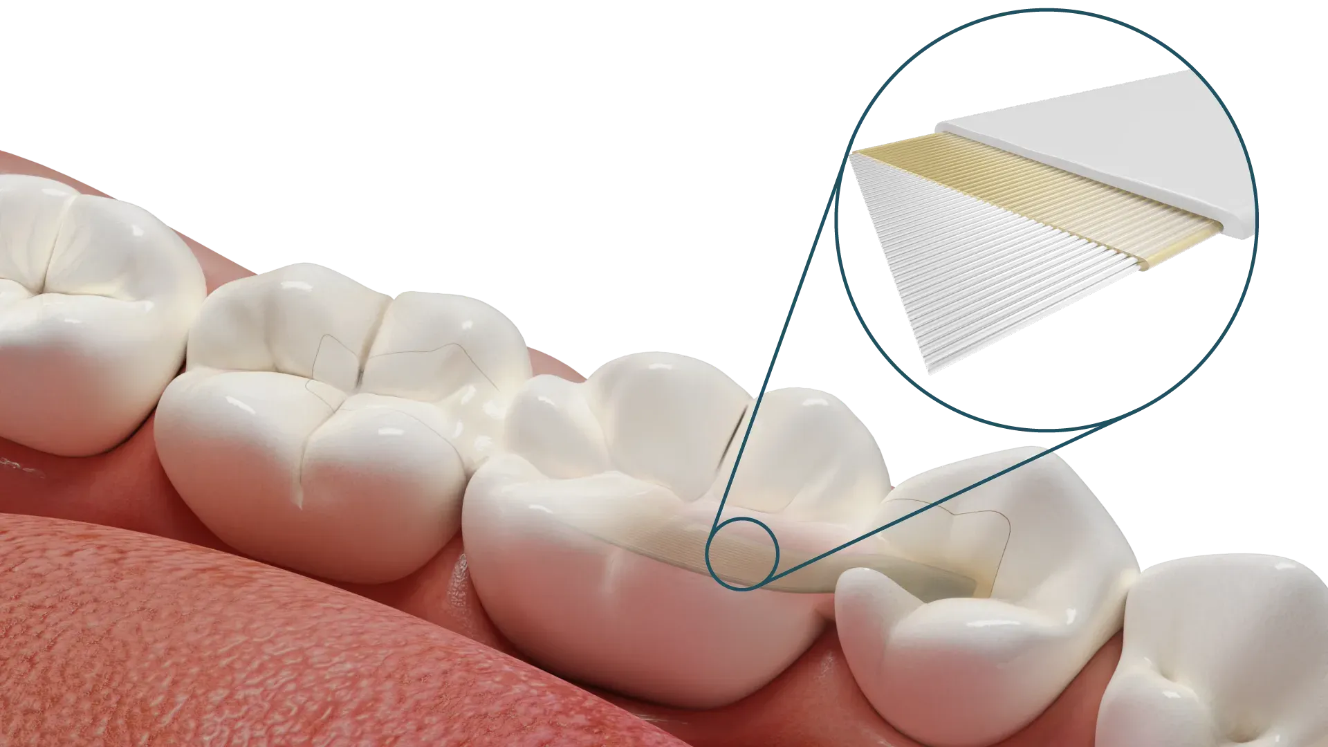 Posterior adhesive bridge solution