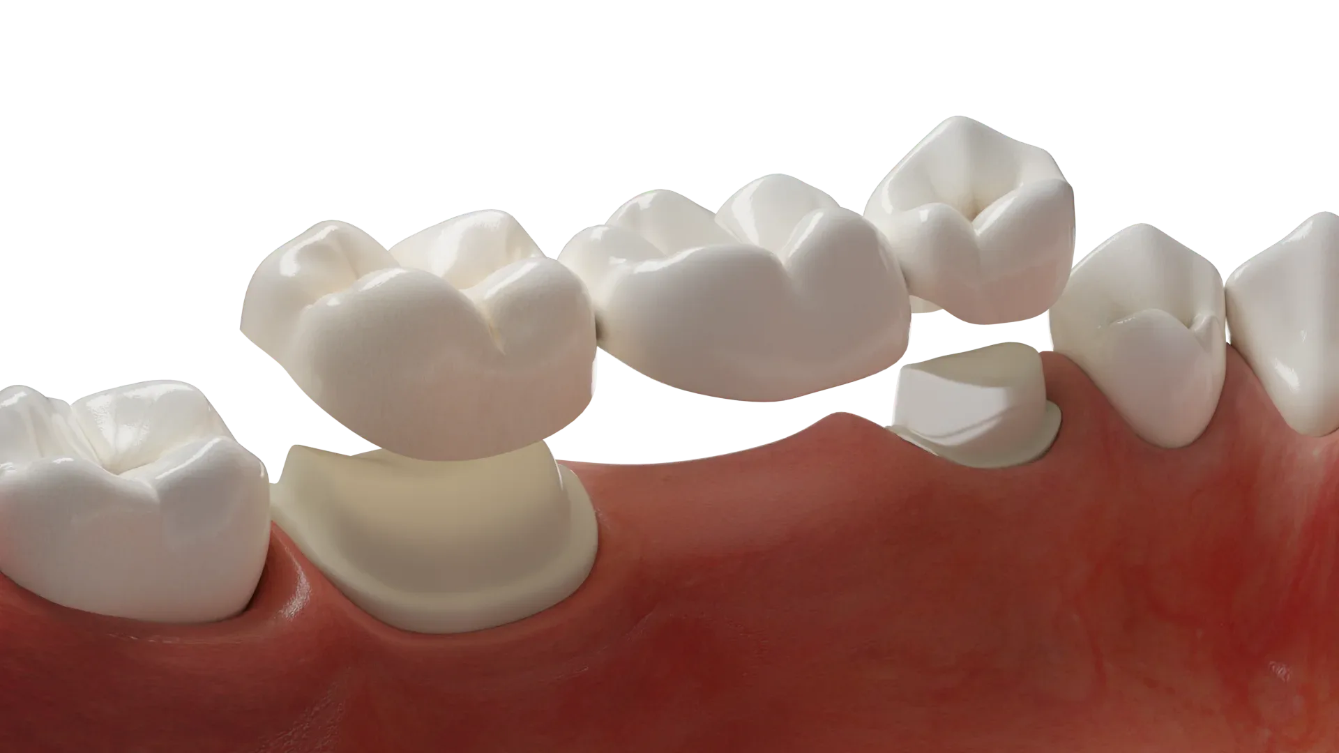 Traditional dental bridge
