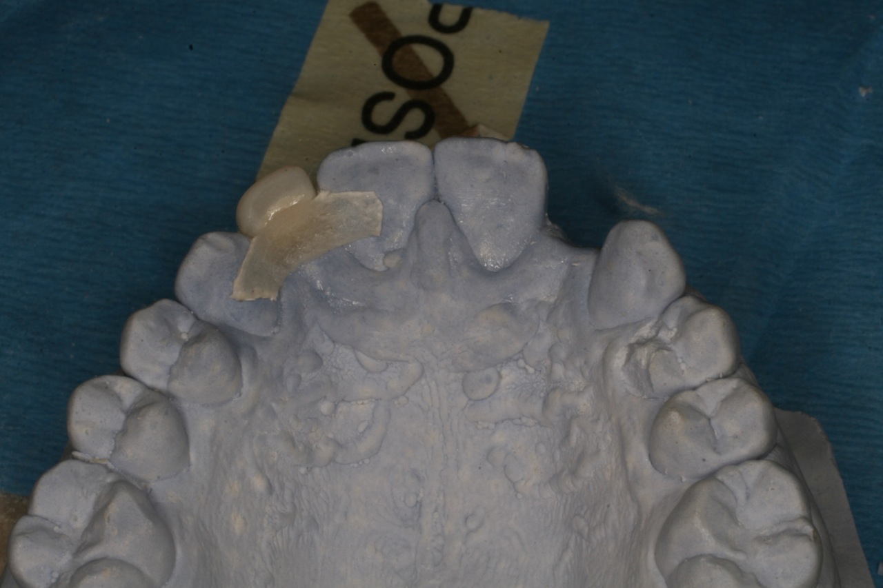 Anterior bridge on a model with Dentapreg BRAID, first step.