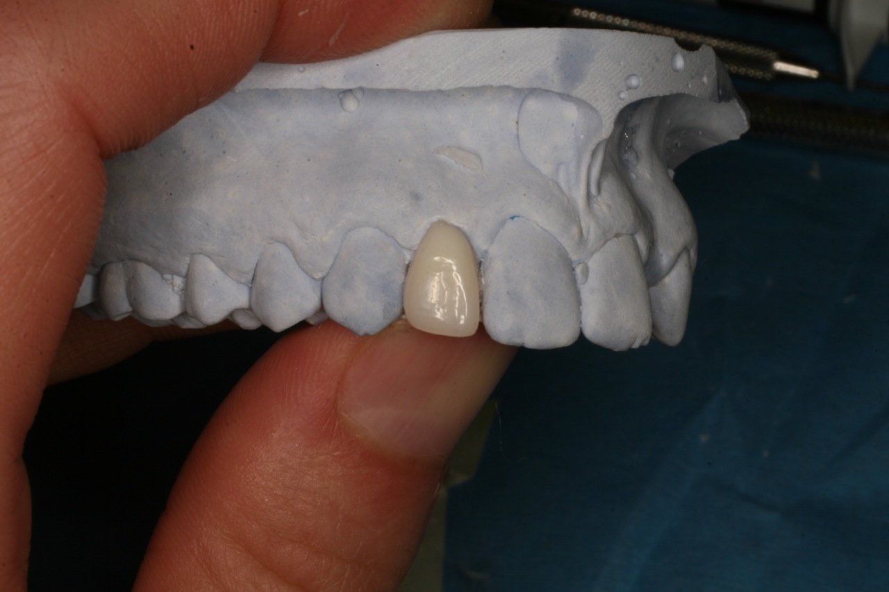 Anterior bridge on a model with Dentapreg BRAID, second step.