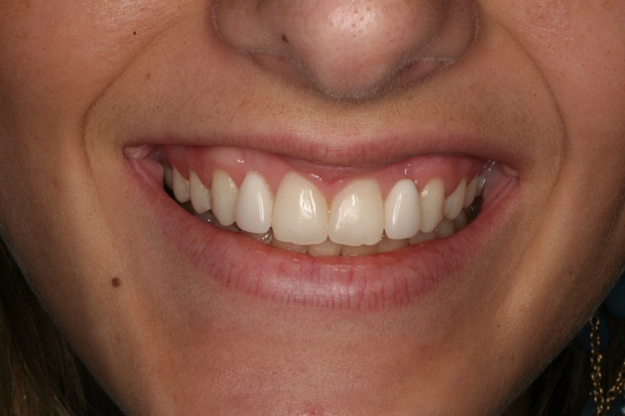 Completed anterior bridge on a model with Dentapreg BRAID.
