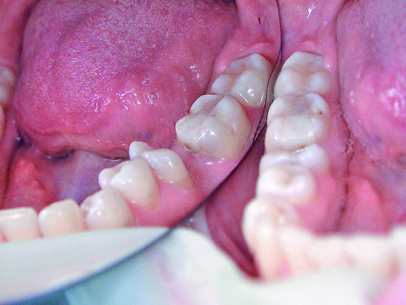 Posterior bridge with Dentapreg BUNDLE, initial clinical situation.