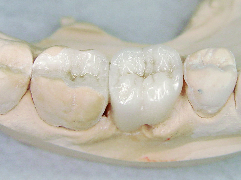 Posterior bridge with Dentapreg BUNDLE, reinforcement placement.