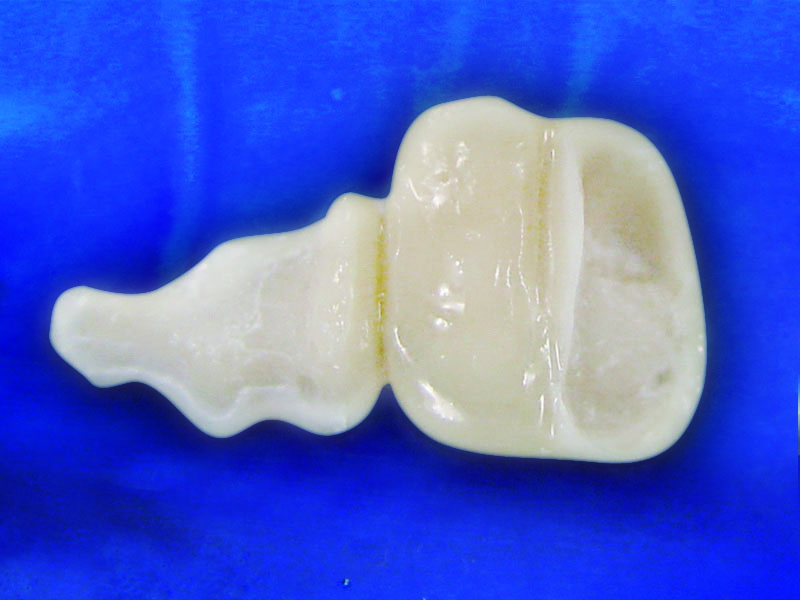 Completed posterior bridge with Dentapreg BUNDLE.