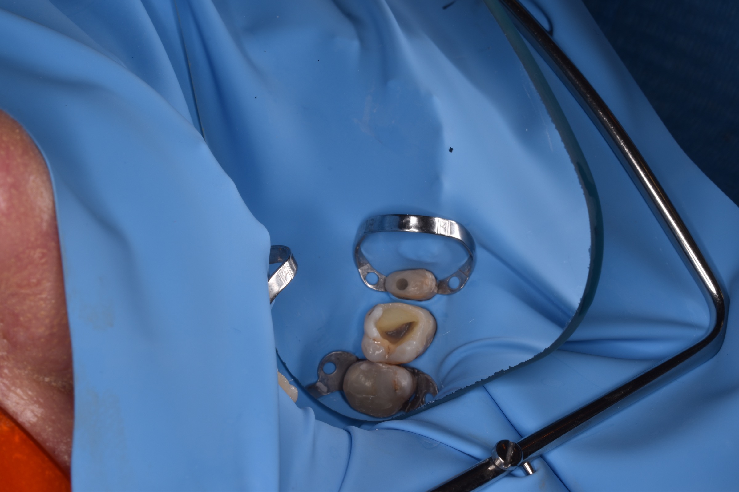 Class I restoration with Fibrafill, intermediate clinical step.