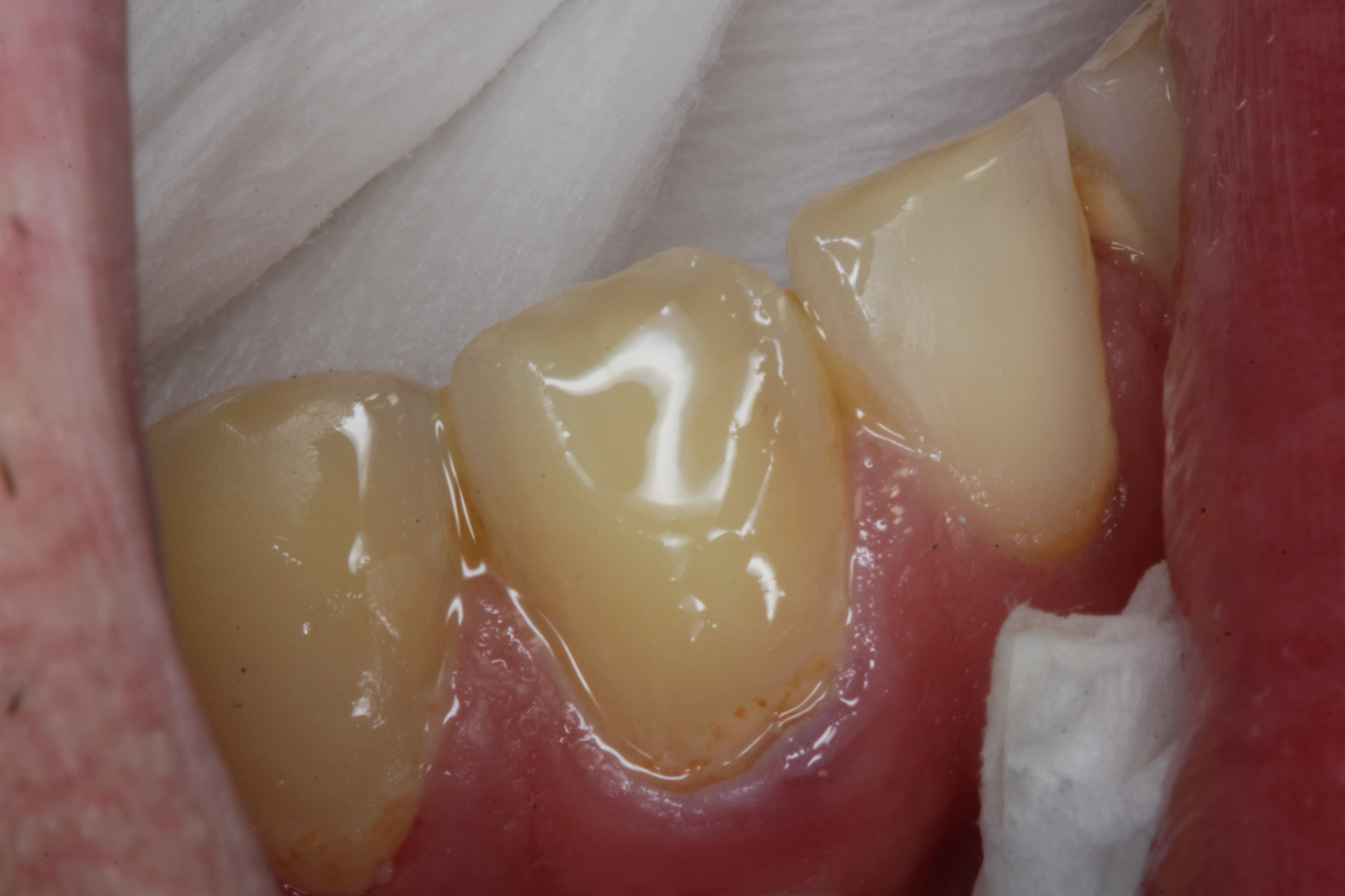 Class II restoration with Dentapreg UFM by Dr. Pazdzior-Klocek, clinical step 01.