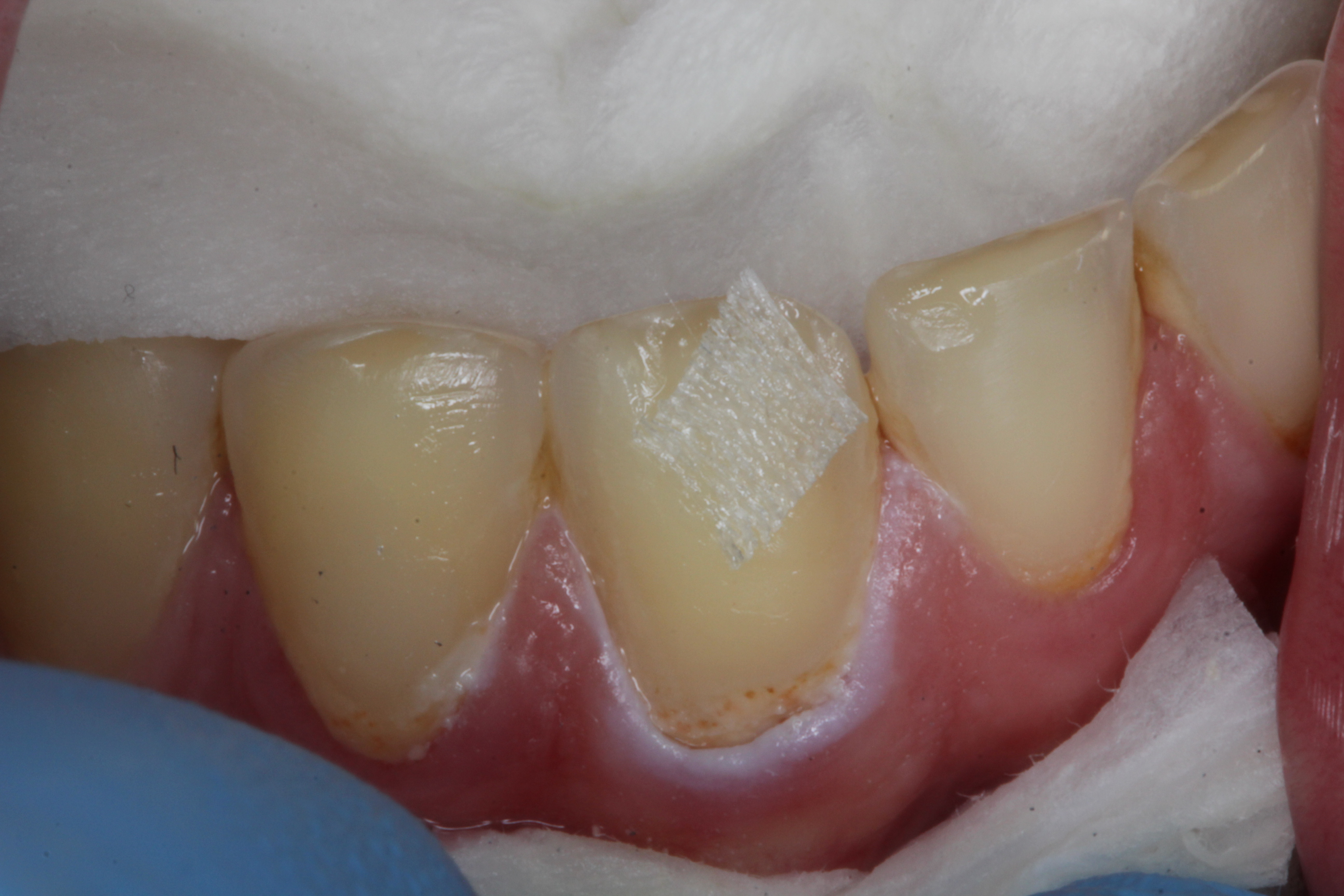 Class II restoration with Dentapreg UFM by Dr. Pazdzior-Klocek, clinical step 03.