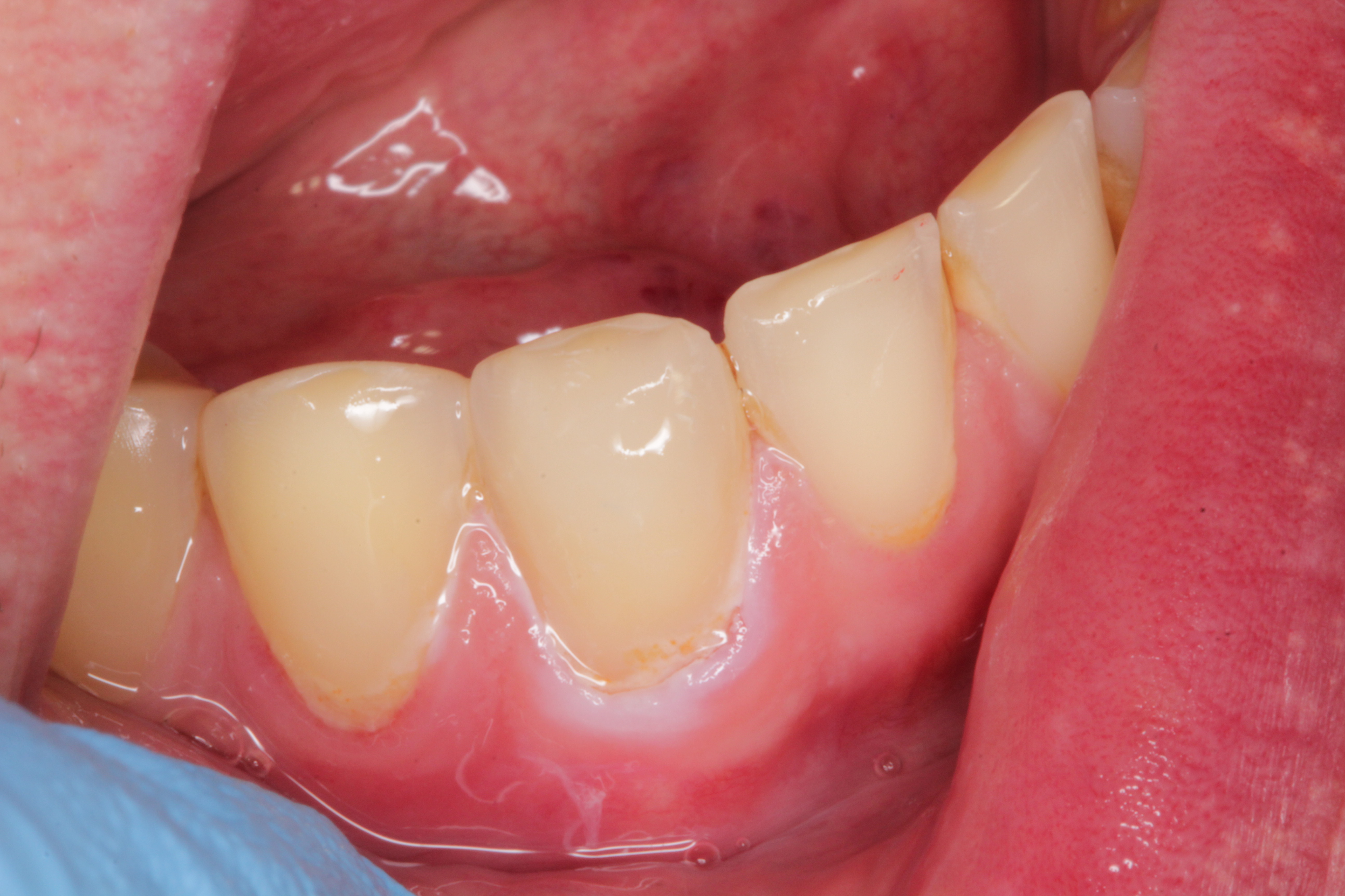 Class II restoration with Dentapreg UFM by Dr. Pazdzior-Klocek, clinical step 05.
