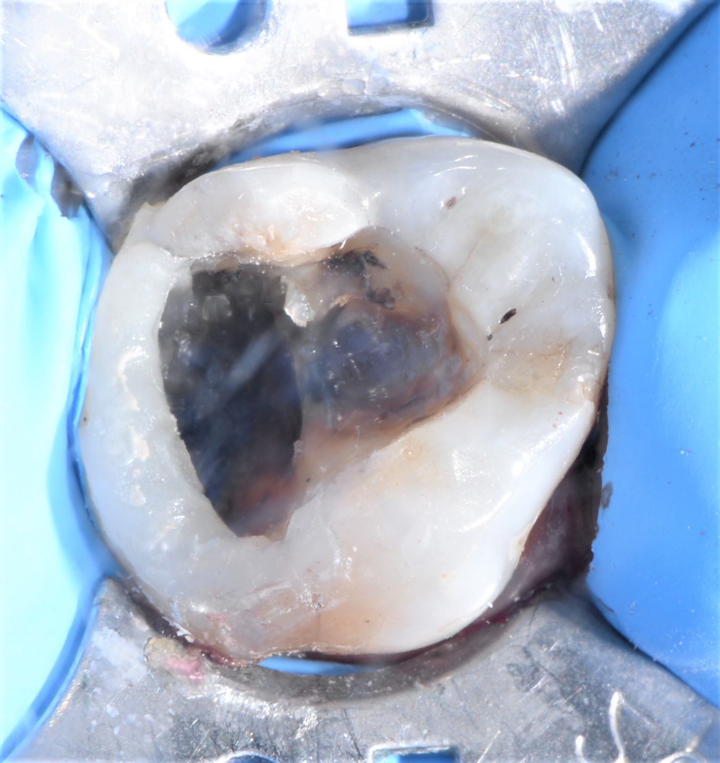 Class II restoration with Fibrafill CUBE and Fibrafill Flow, clinical step 5399.