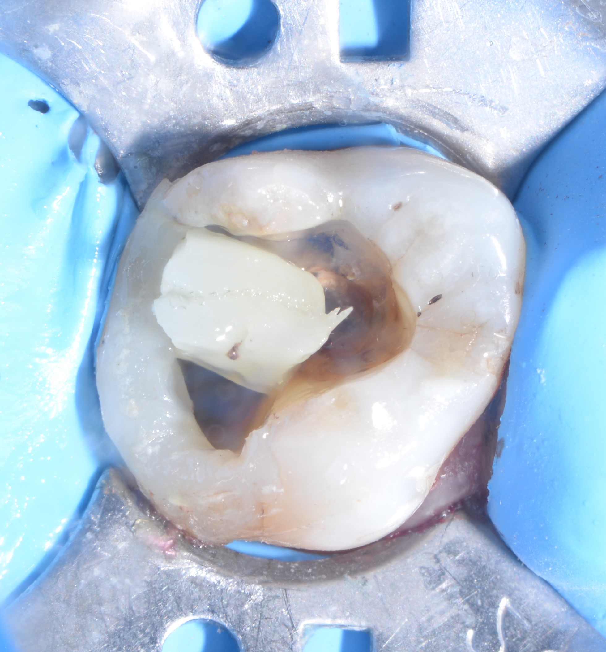Class II restoration with Fibrafill CUBE and Fibrafill Flow, clinical step 5402.