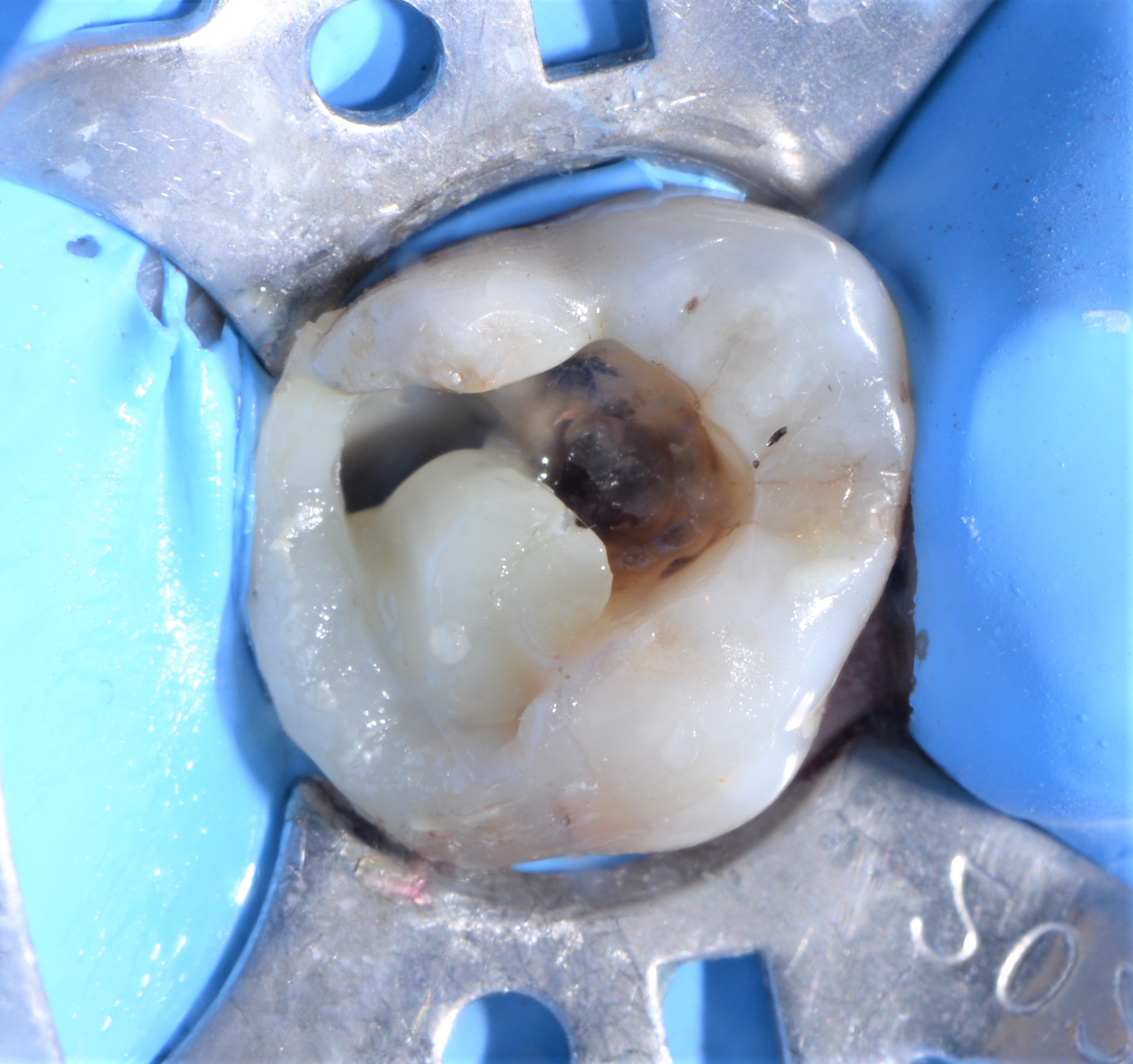 Class II restoration with Fibrafill CUBE and Fibrafill Flow, clinical step 5404.