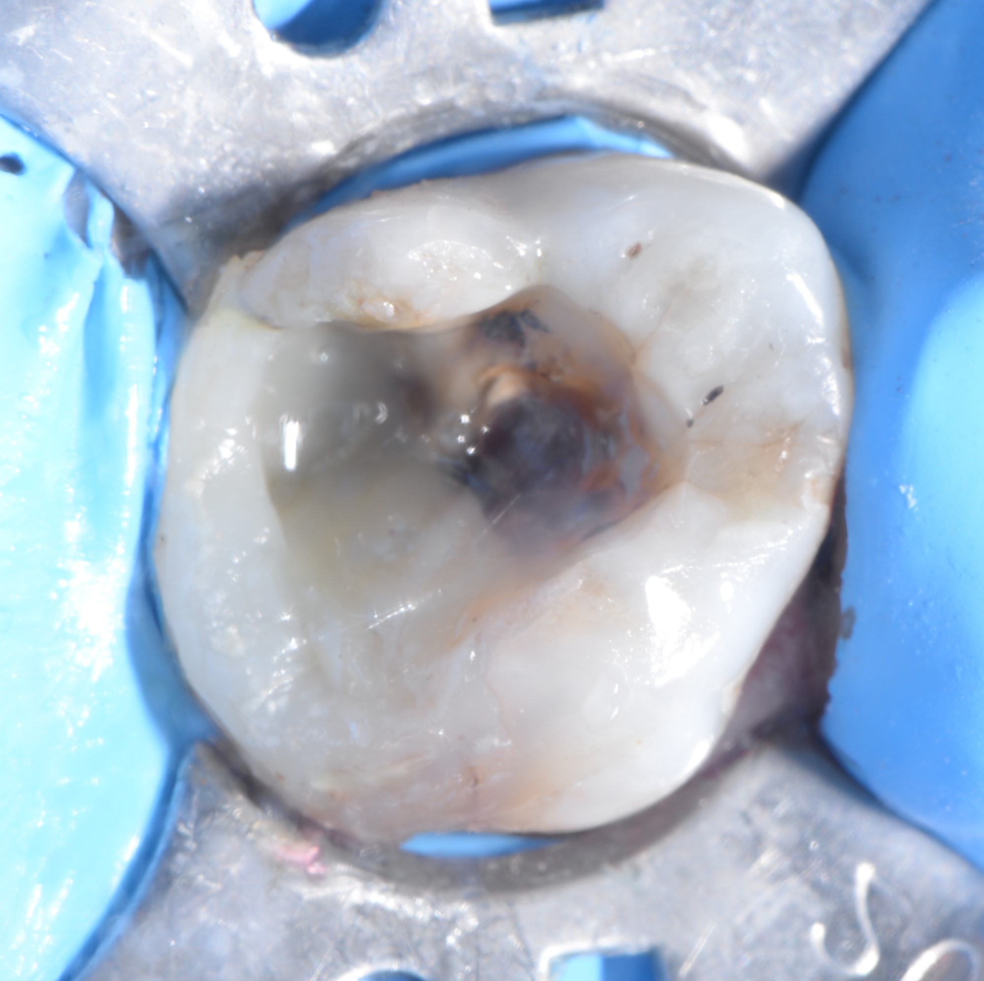 Class II restoration with Fibrafill CUBE and Fibrafill Flow, clinical step 5406.