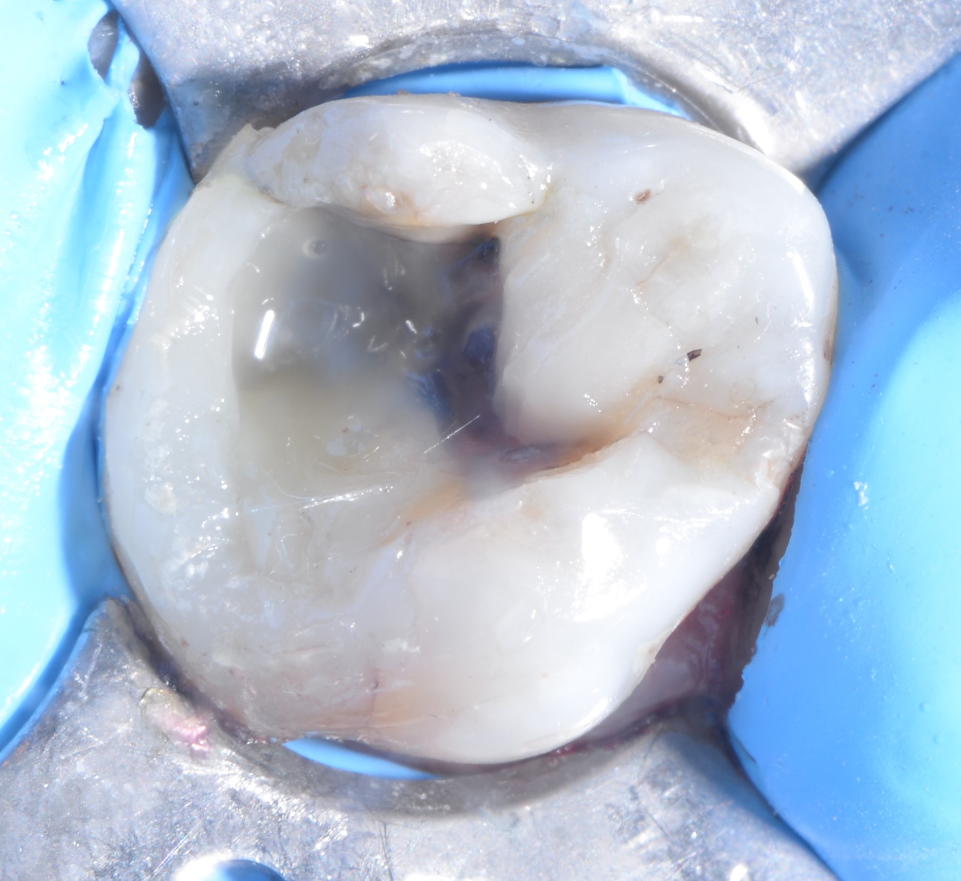 Class II restoration with Fibrafill CUBE and Fibrafill Flow, clinical step 5407.