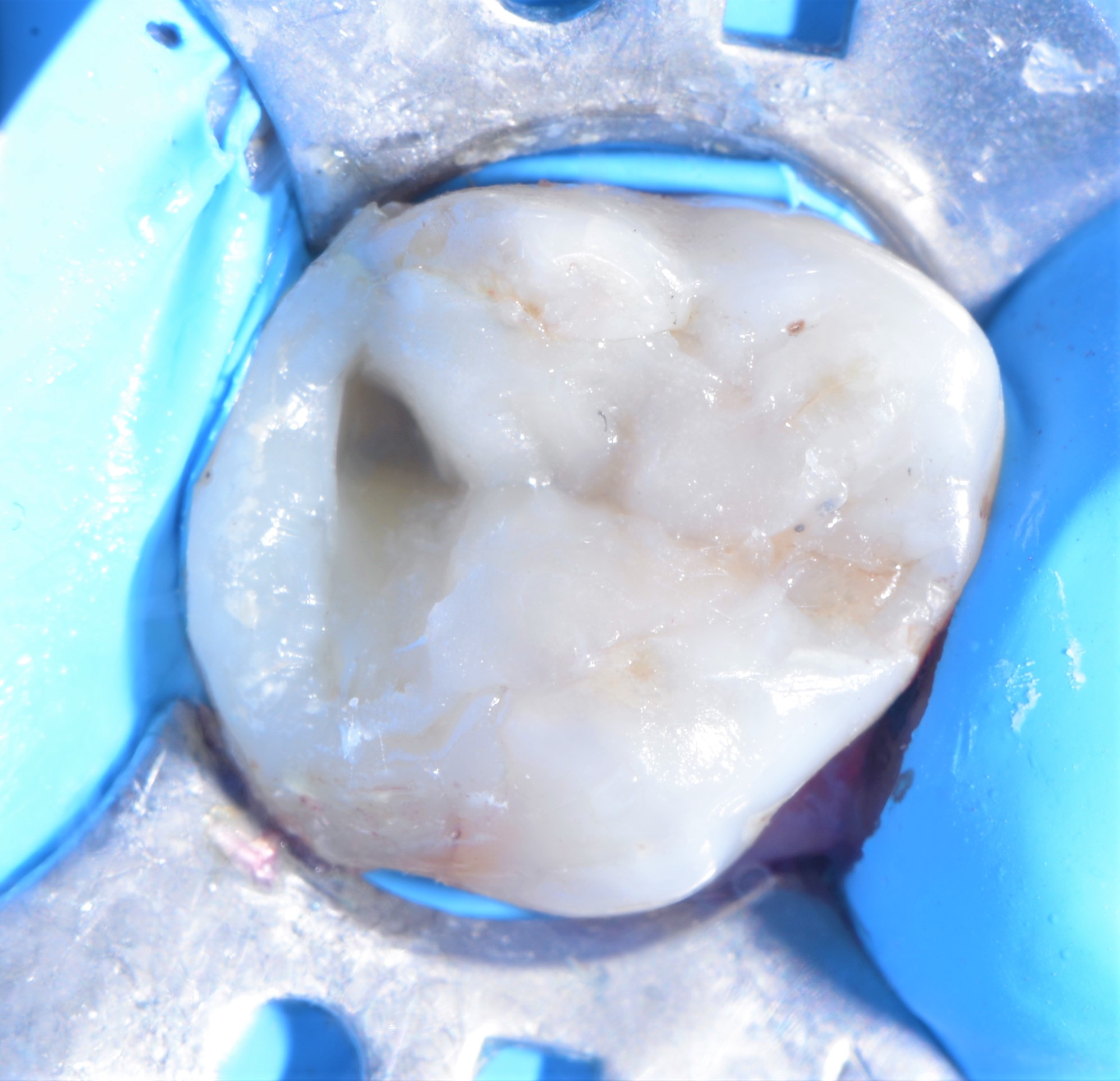 Class II restoration with Fibrafill CUBE and Fibrafill Flow, clinical step 5410.