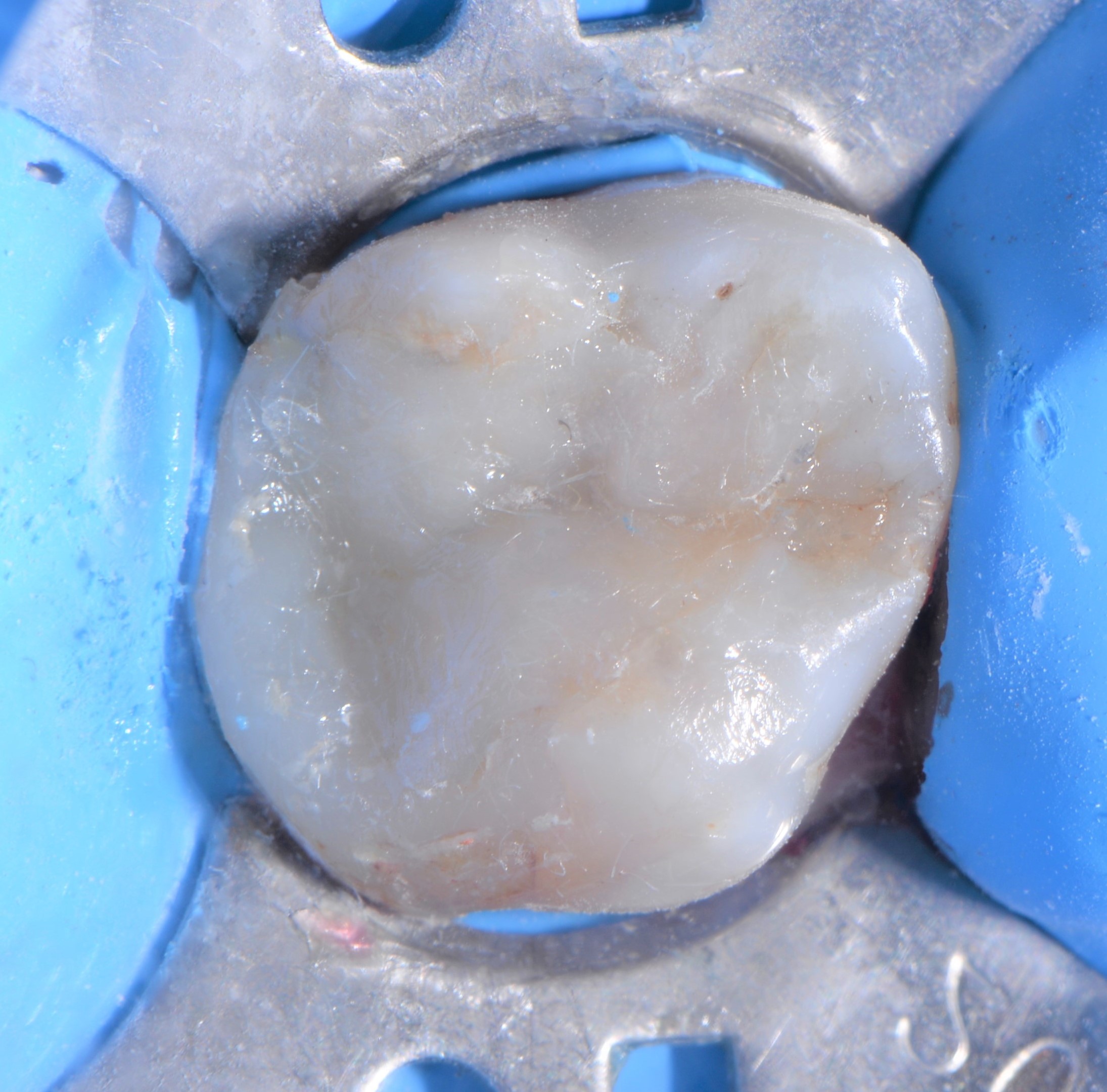 Class II restoration with Fibrafill CUBE and Fibrafill Flow, clinical step 5414.