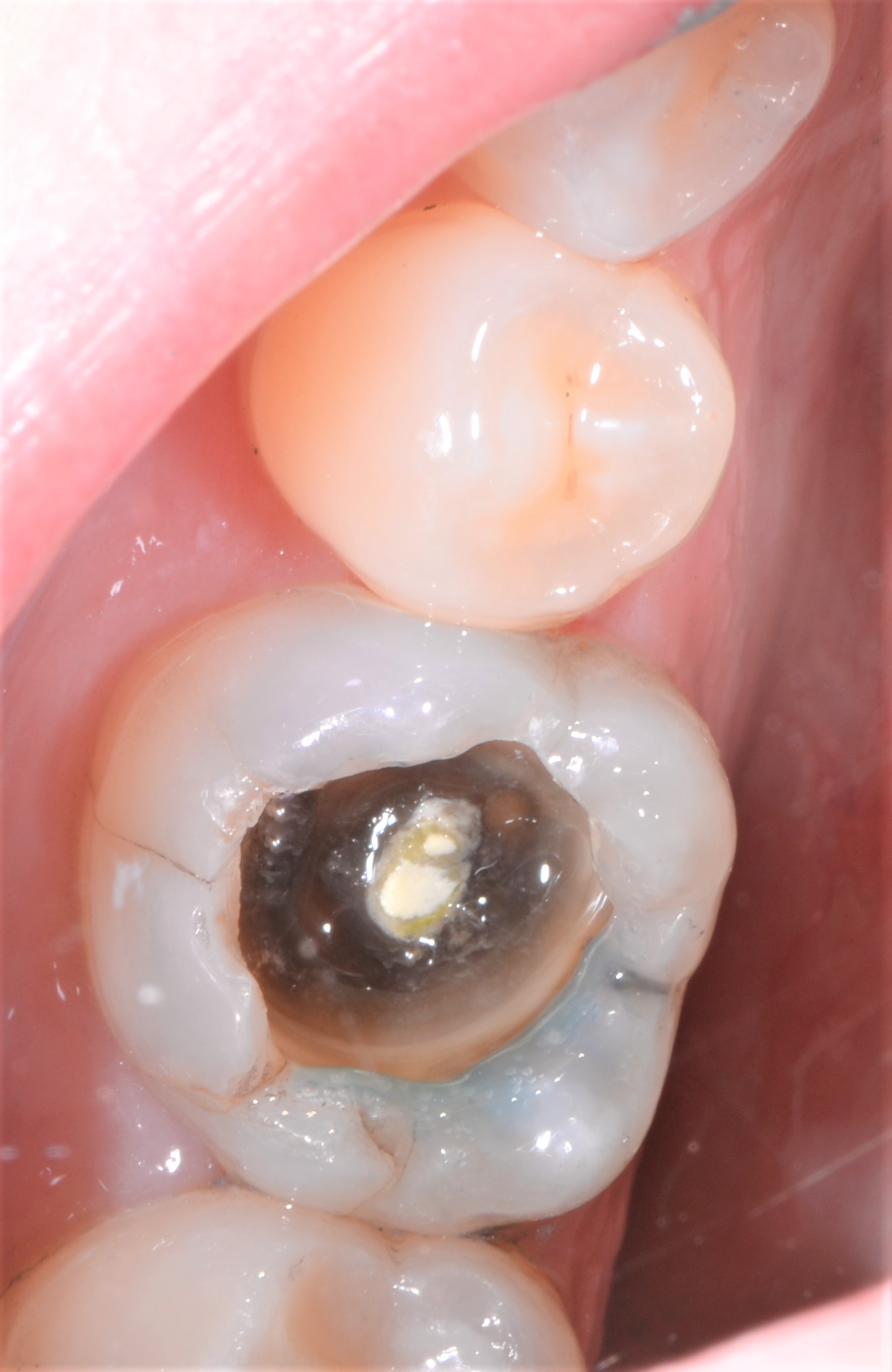 Class II restoration with Fibrafill CUBE and Fibrafill Flow, clinical step 4913.