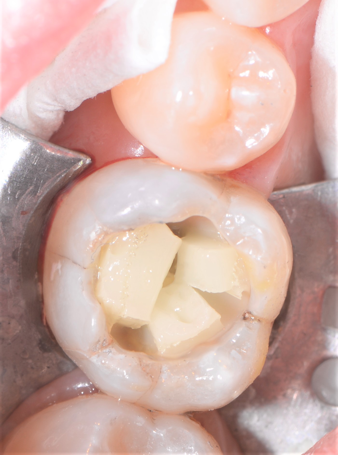Class II restoration with Fibrafill CUBE and Fibrafill Flow, clinical step 4916.