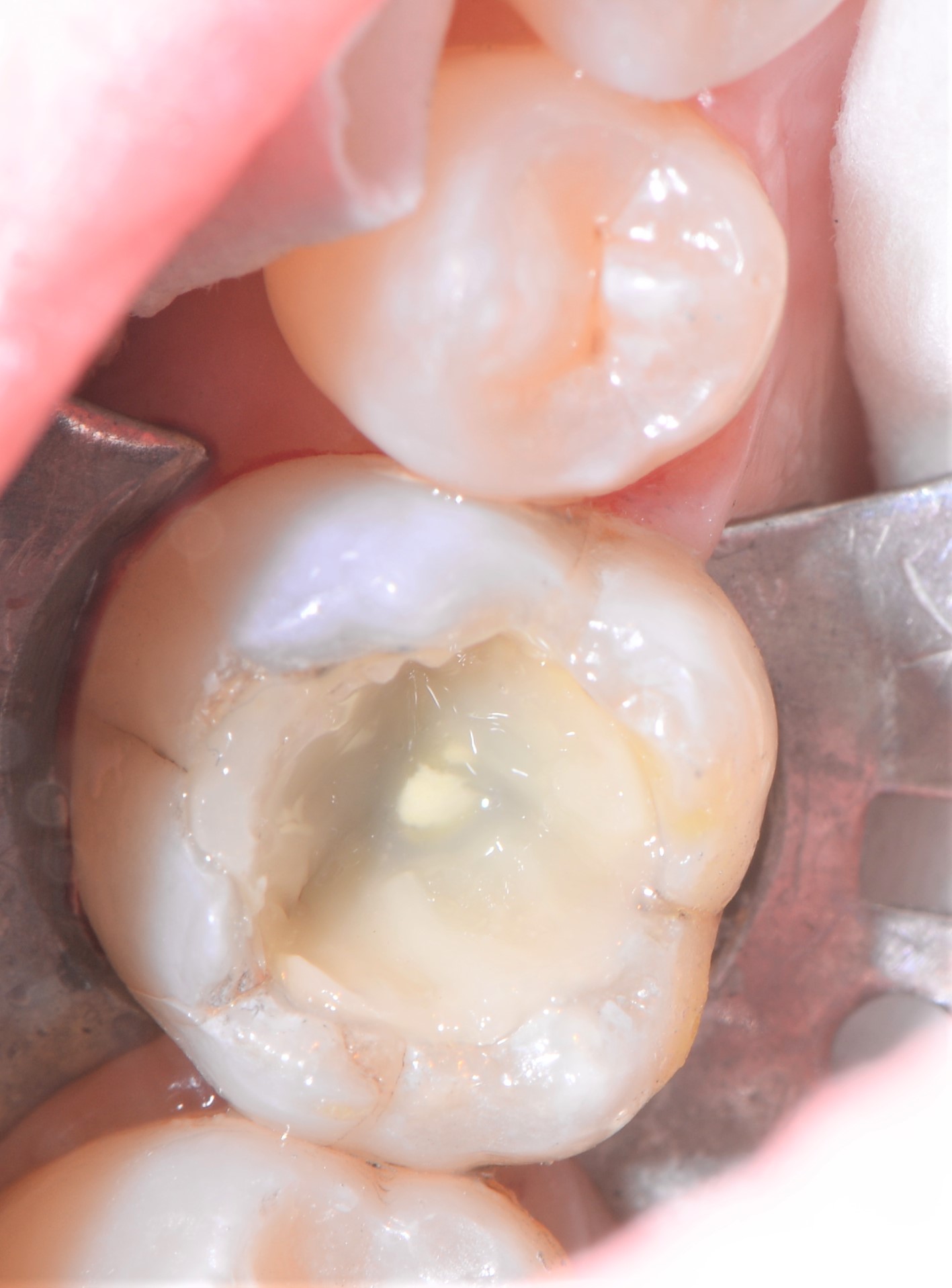 Class II restoration with Fibrafill CUBE and Fibrafill Flow, clinical step 4918.