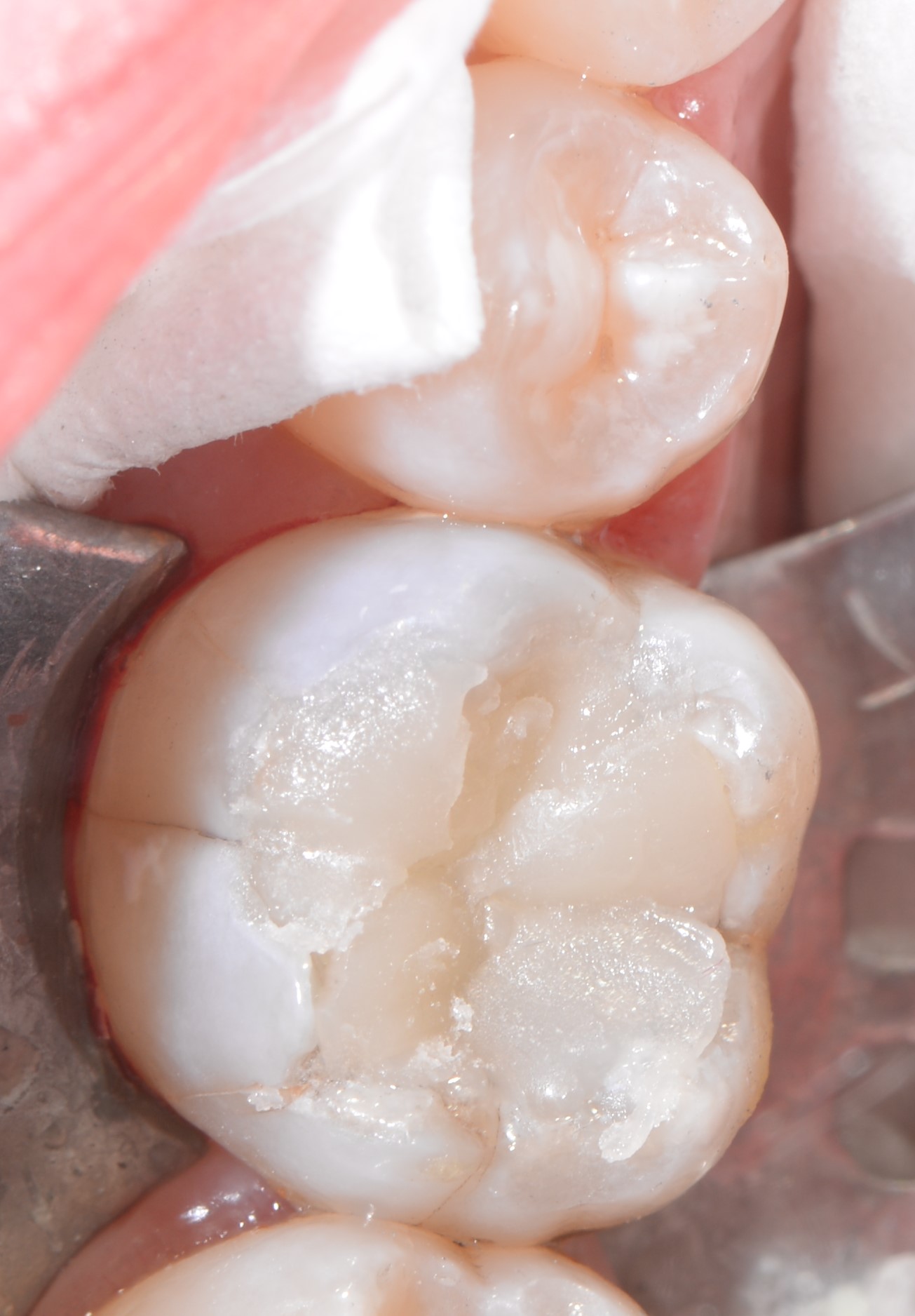 Class II restoration with Fibrafill CUBE and Fibrafill Flow, clinical step 4927.