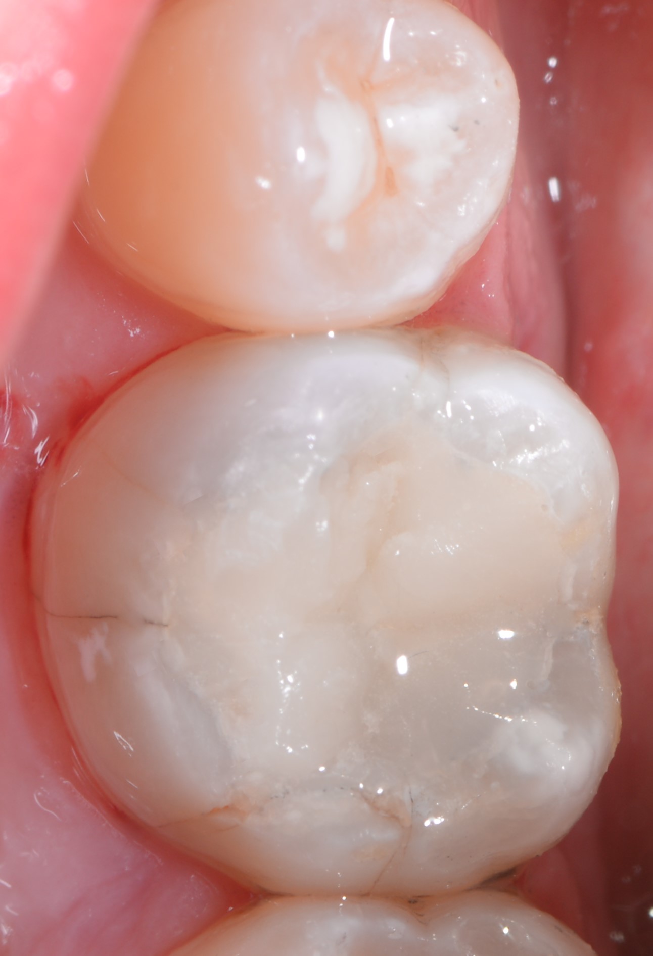 Class II restoration with Fibrafill CUBE and Fibrafill Flow, clinical step 4930.