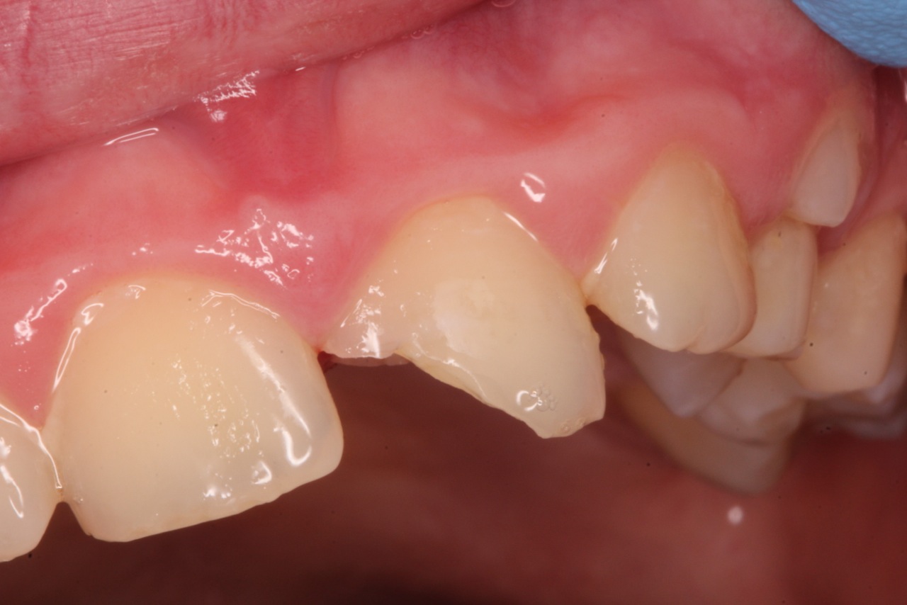 Class IV restoration with Dentapreg UFM by Dr. Pazdzior-Klocek, clinical step 02.