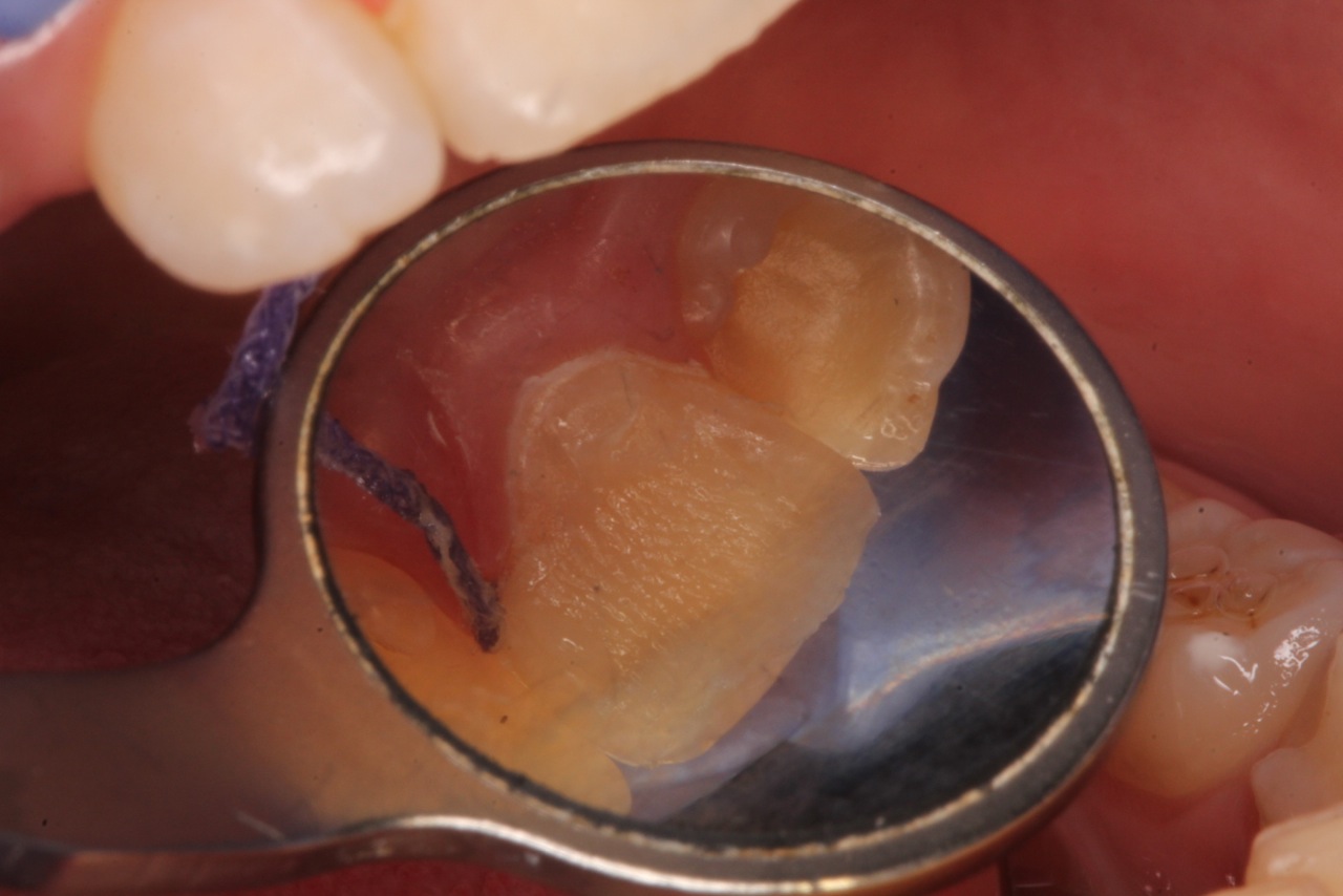 Class IV restoration with Dentapreg UFM by Dr. Pazdzior-Klocek, clinical step 05.