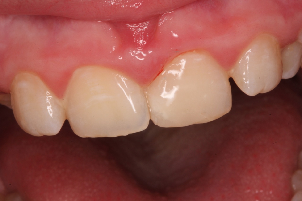 Class IV restoration with Dentapreg UFM by Dr. Pazdzior-Klocek, clinical step 06.