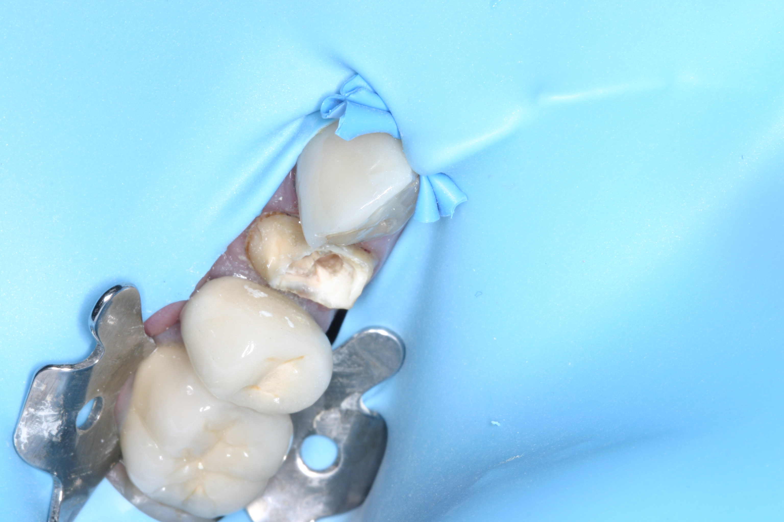 Core build-up with Fibrafill Flow by Dr. David Poiman, clinical step 0150.