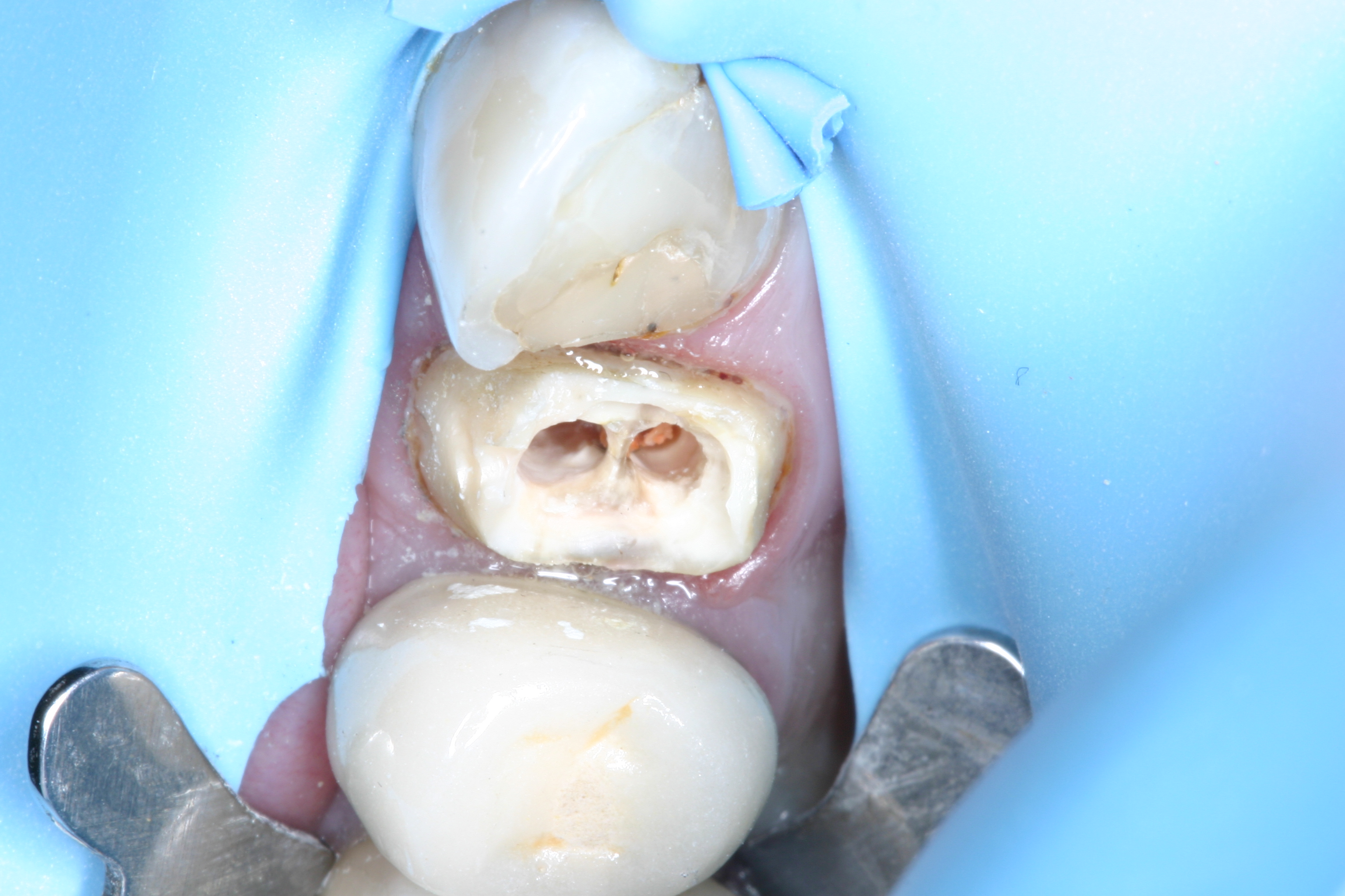 Core build-up with Fibrafill Flow by Dr. David Poiman, clinical step 0152.