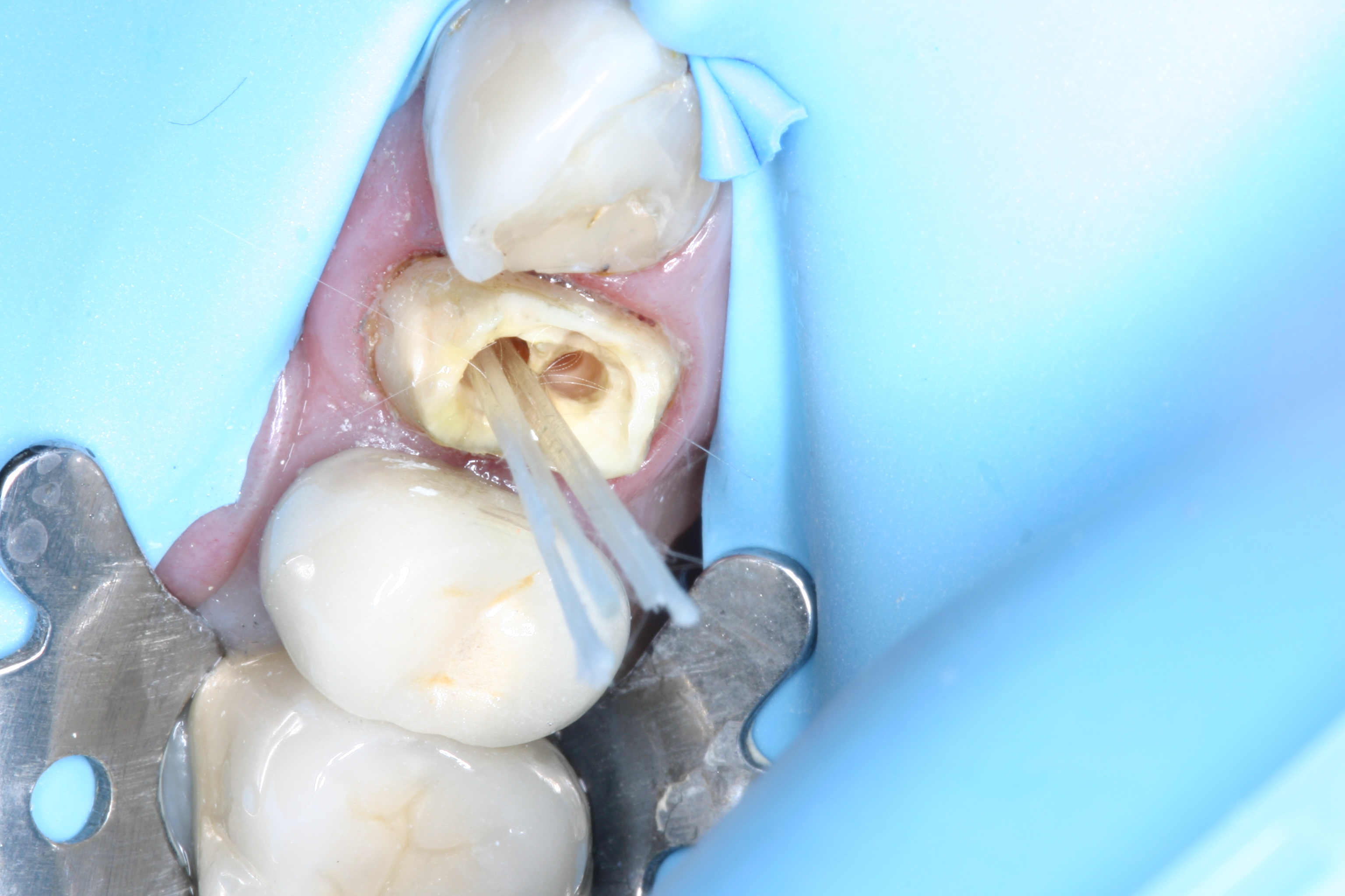Core build-up with Fibrafill Flow by Dr. David Poiman, clinical step 0153.