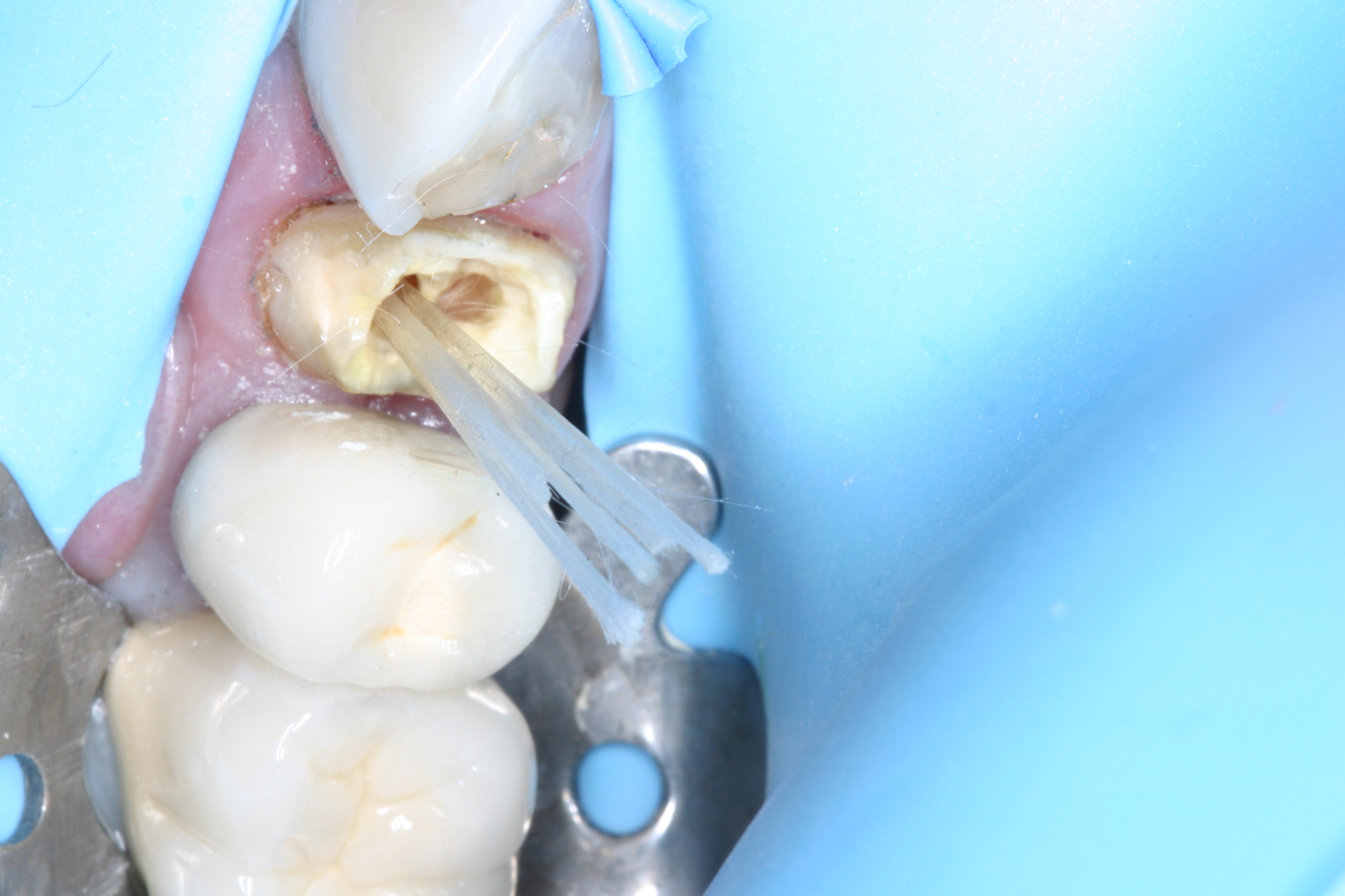 Core build-up with Fibrafill Flow by Dr. David Poiman, clinical step 0156.