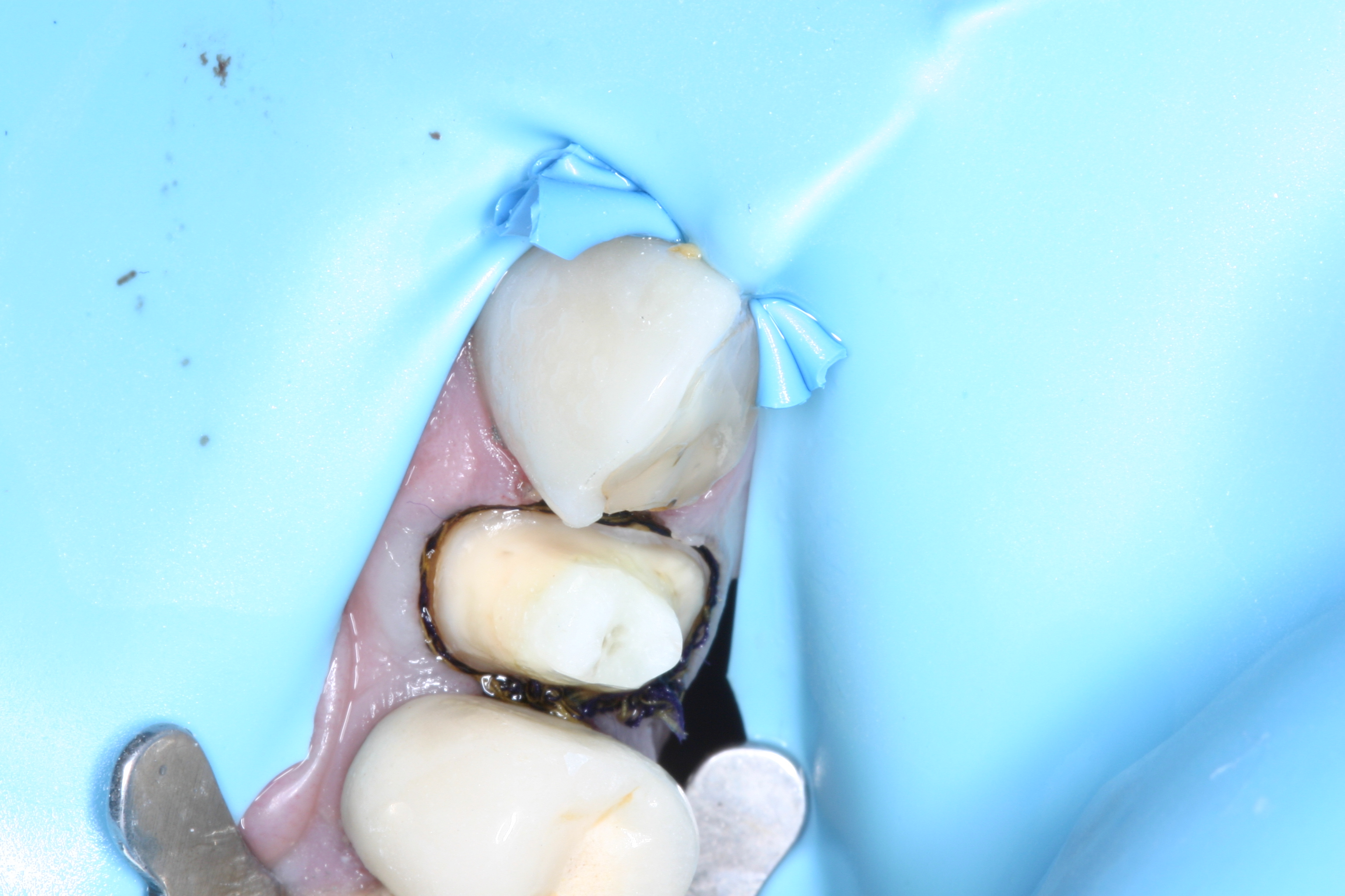Core build-up with Fibrafill Flow by Dr. David Poiman, clinical step 0160.