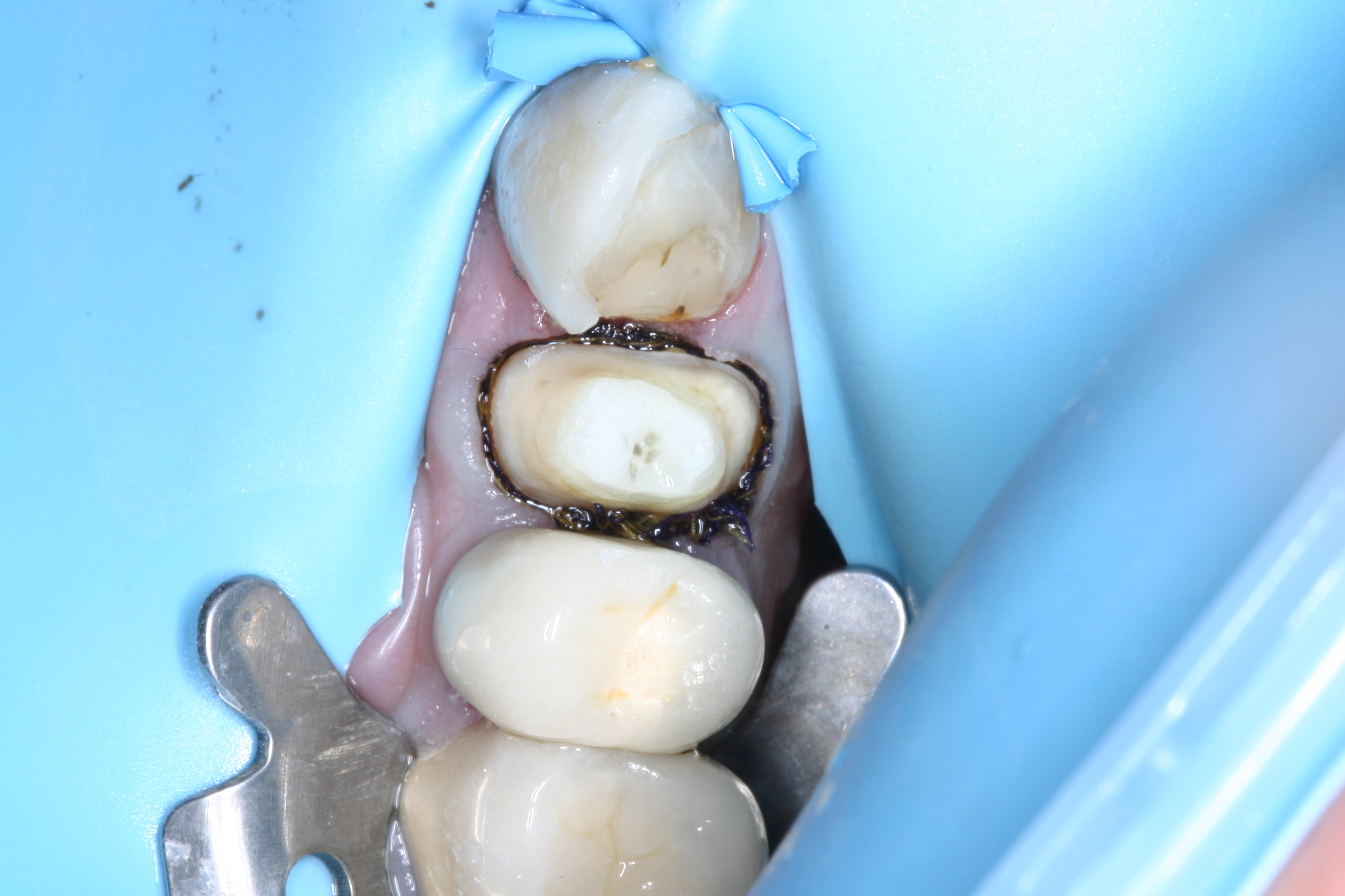 Core build-up with Fibrafill Flow by Dr. David Poiman, clinical step 0162.