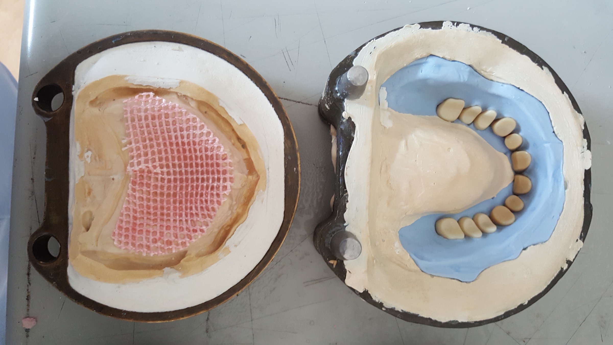Denture reinforcement with Dentapreg MESH, first clinical step.