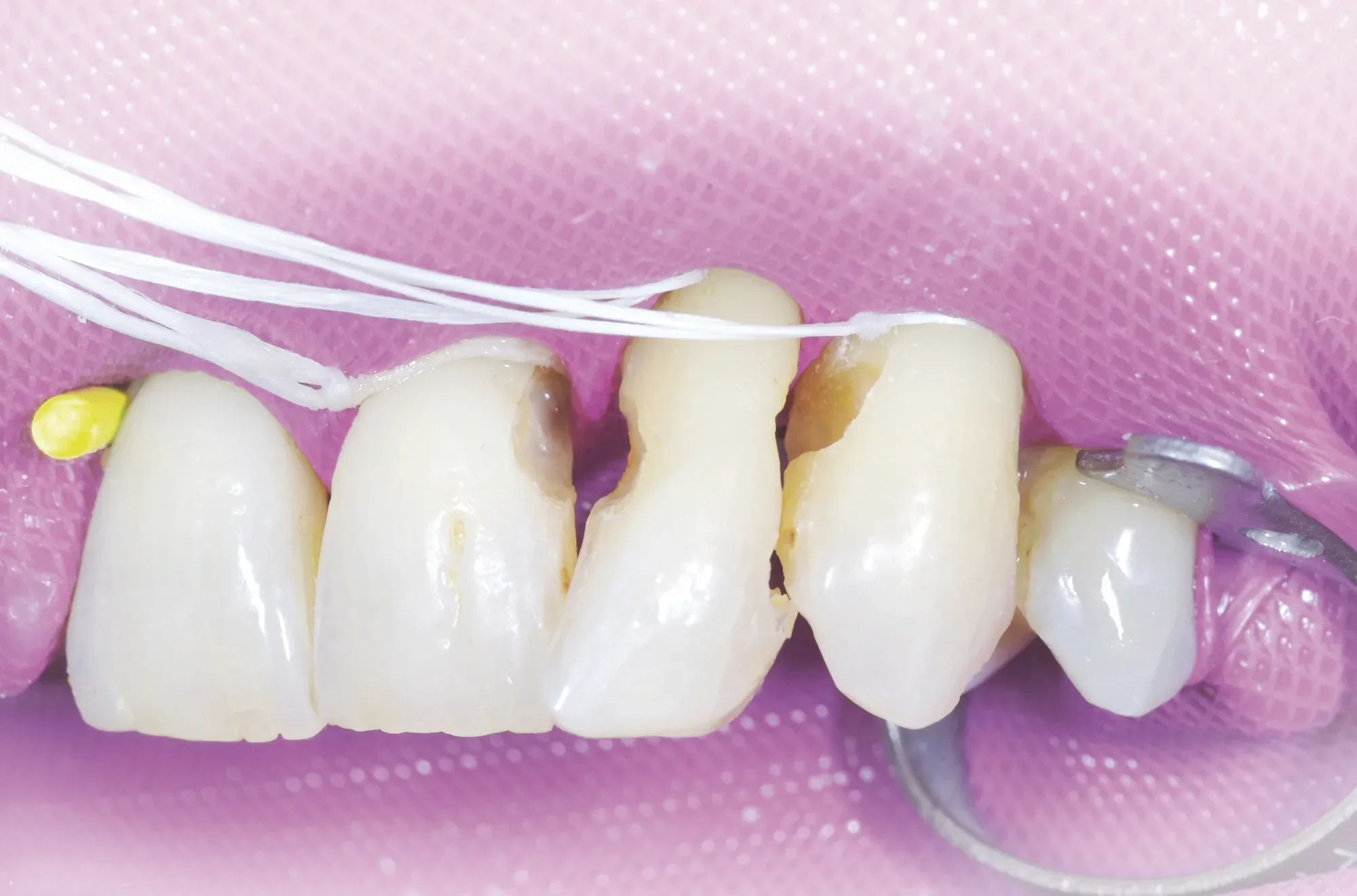 Initial placement of Dentapreg SFM strip by Dr. Biebel for oral splinting.