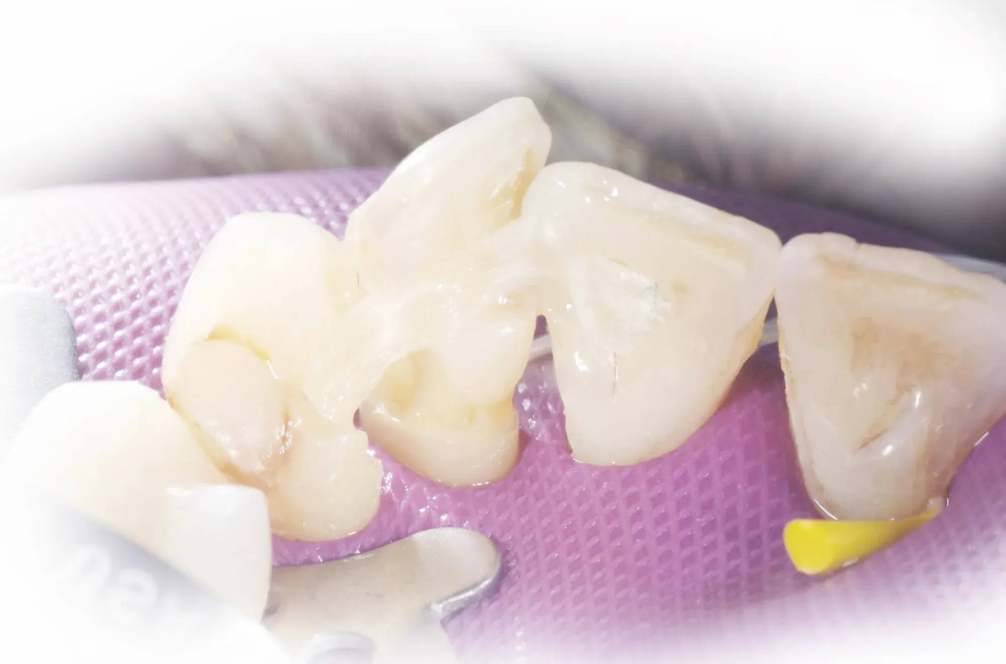 Mid-procedure adjustment of the Dentapreg SFM oral splint by Dr. Biebel.