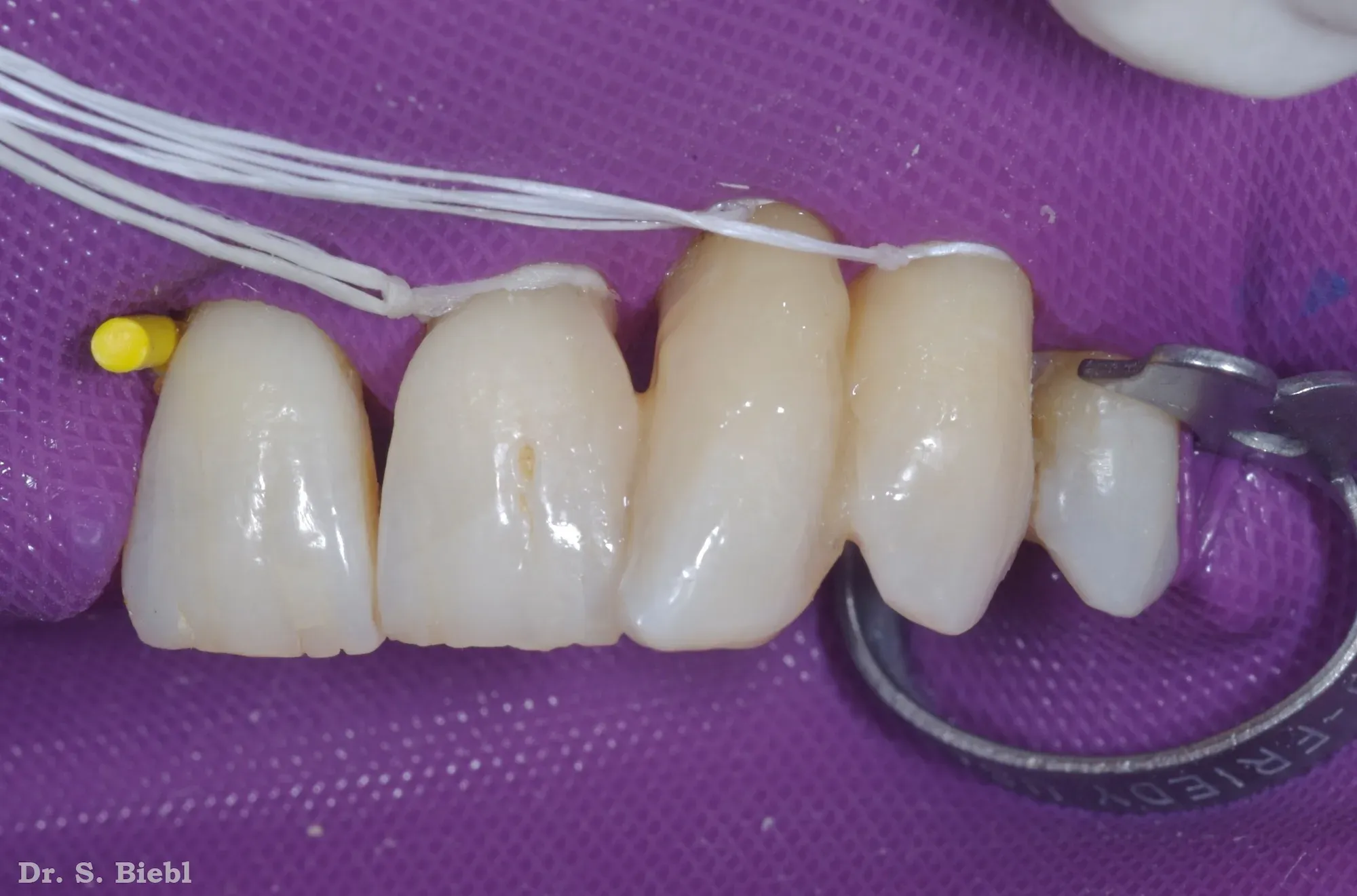 Completed oral splint with Dentapreg SFM by Dr. Biebel.