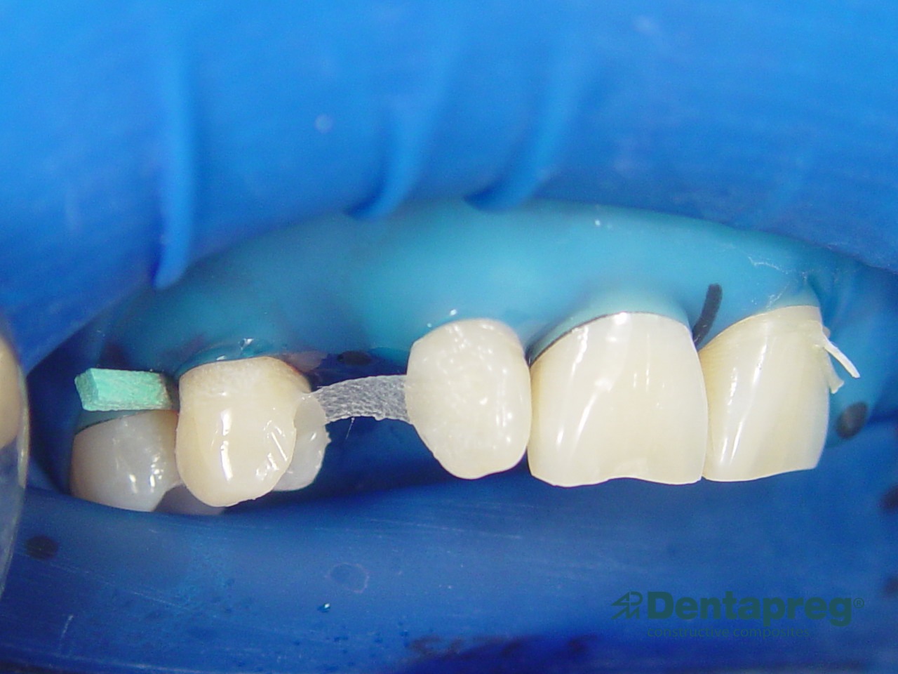 Anterior bridge with Dentapreg PFM, preparation.