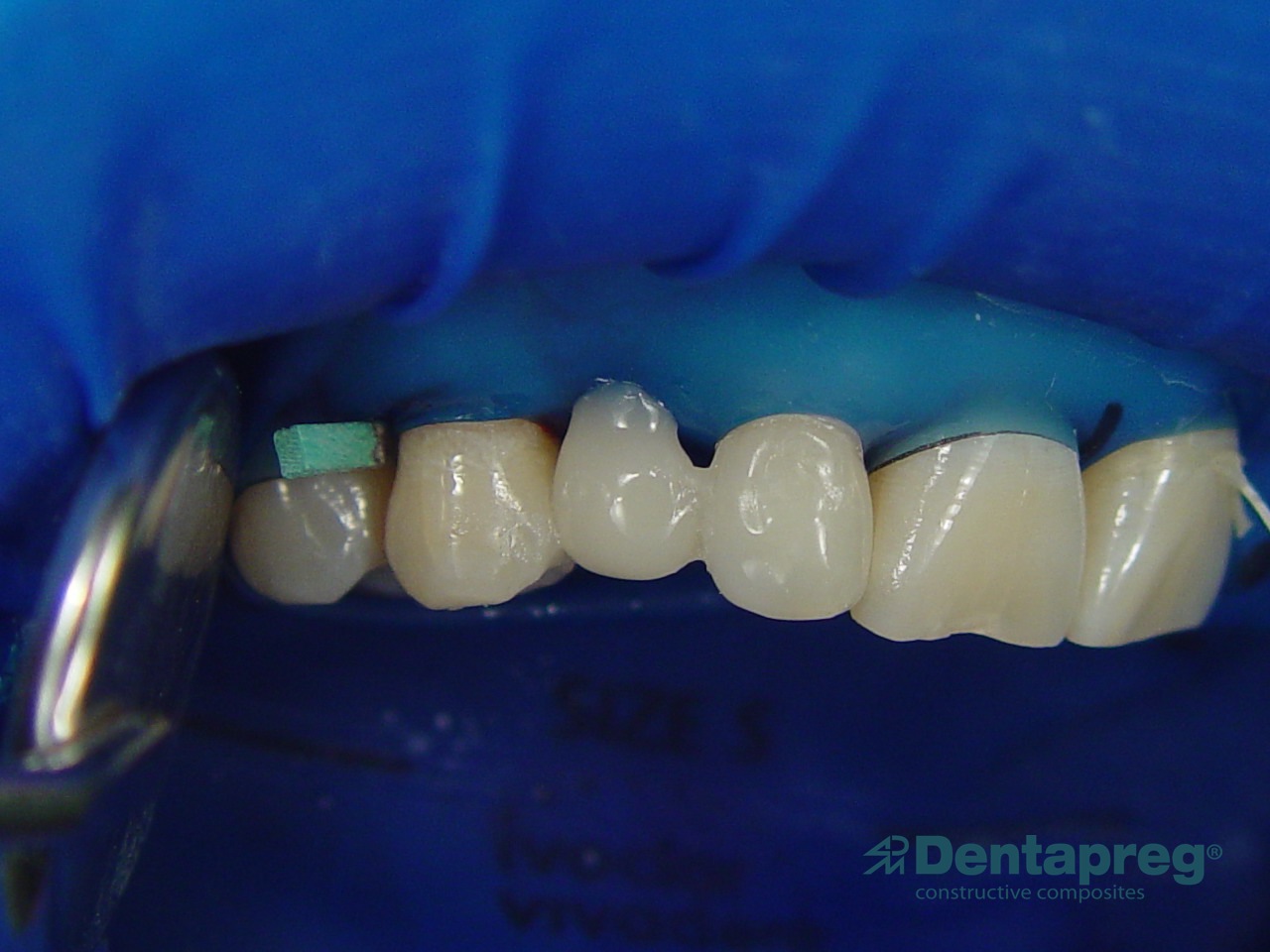 Anterior bridge with Dentapreg PFM, clinical try-in.