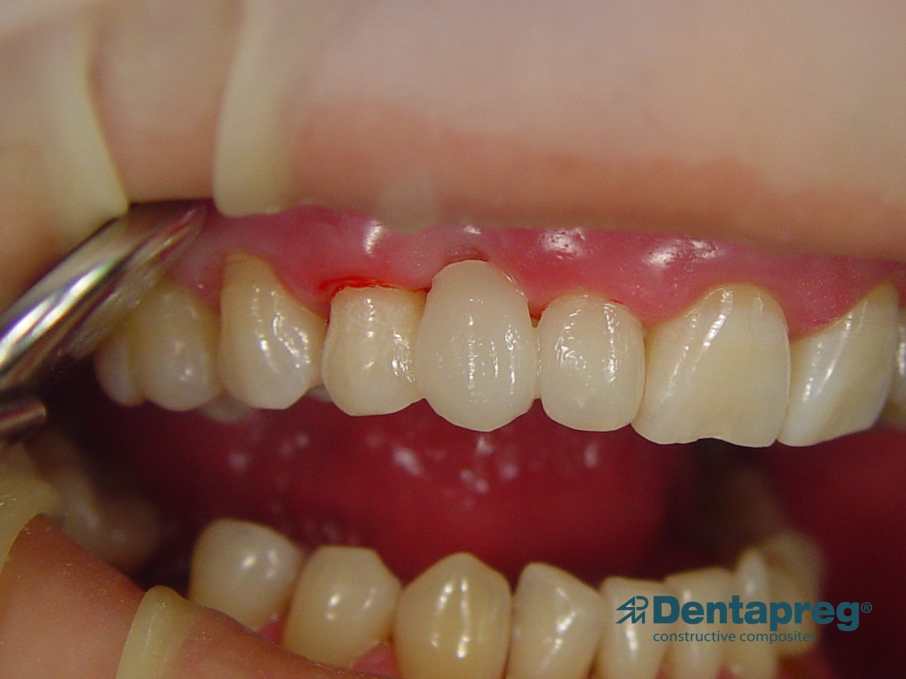 Completed anterior bridge with Dentapreg PFM.