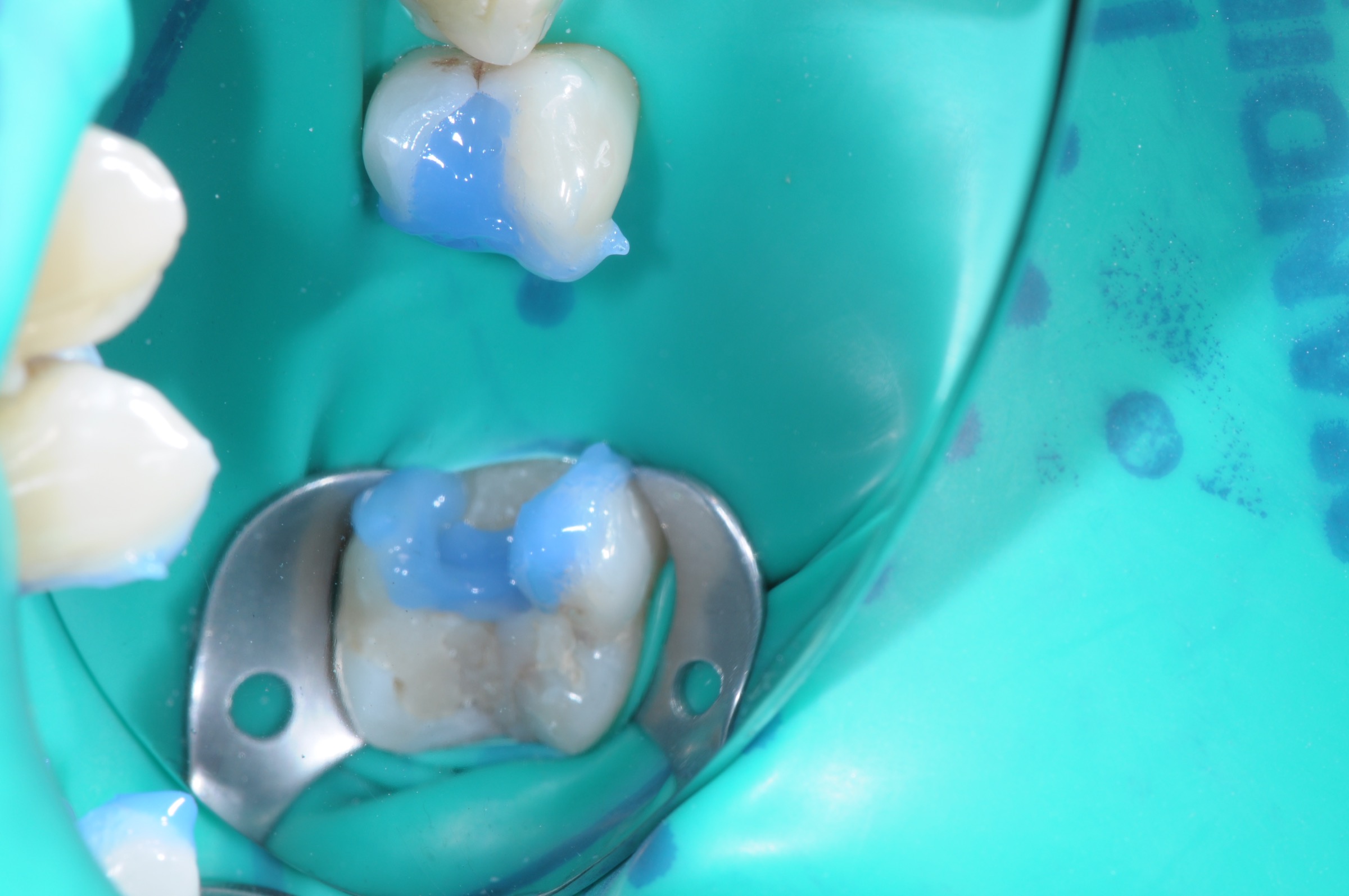 Posterior bridge with Dentapreg PFU, initial clinical situation.