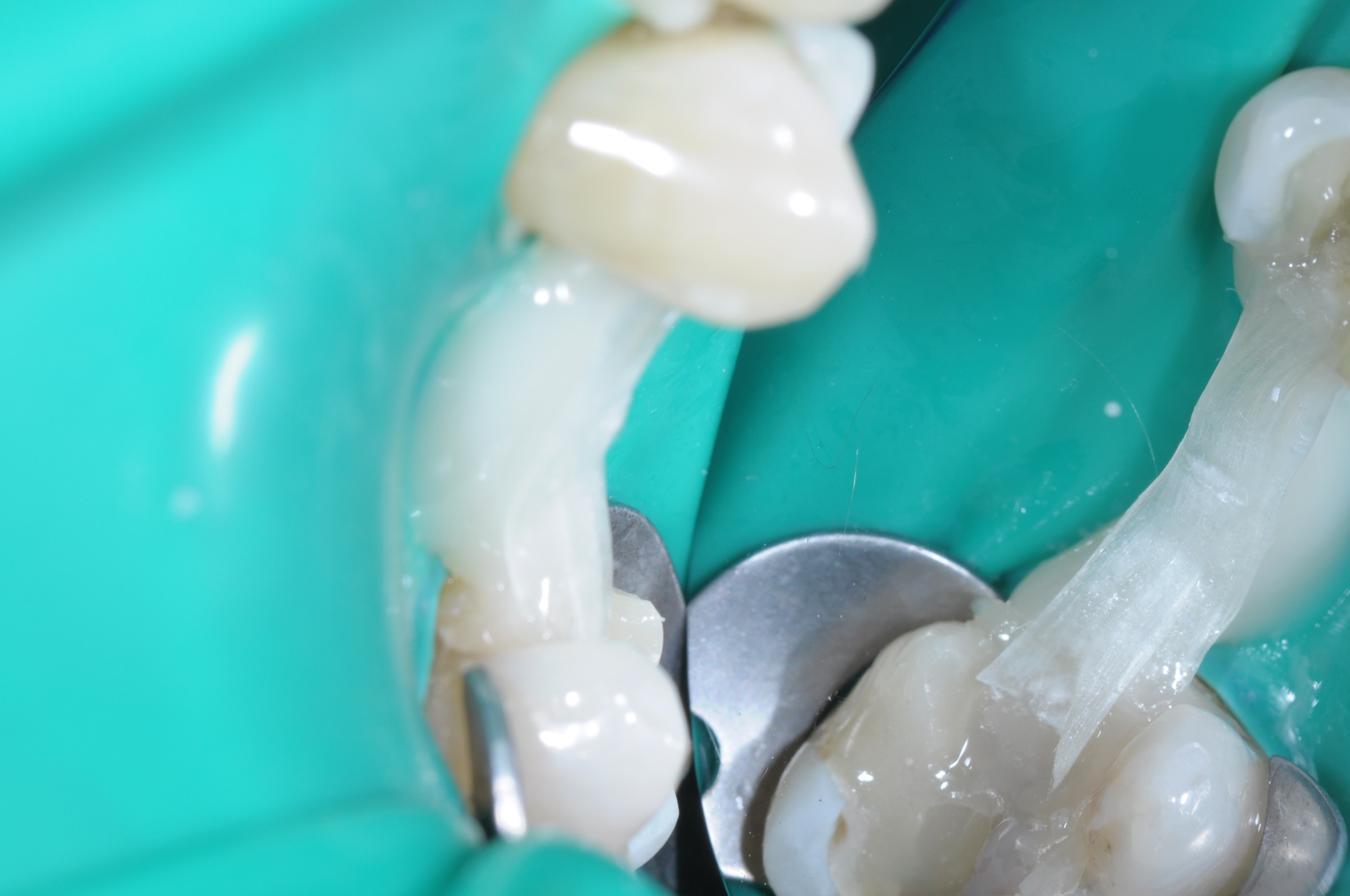 Posterior bridge with Dentapreg PFU, reinforcement placement.