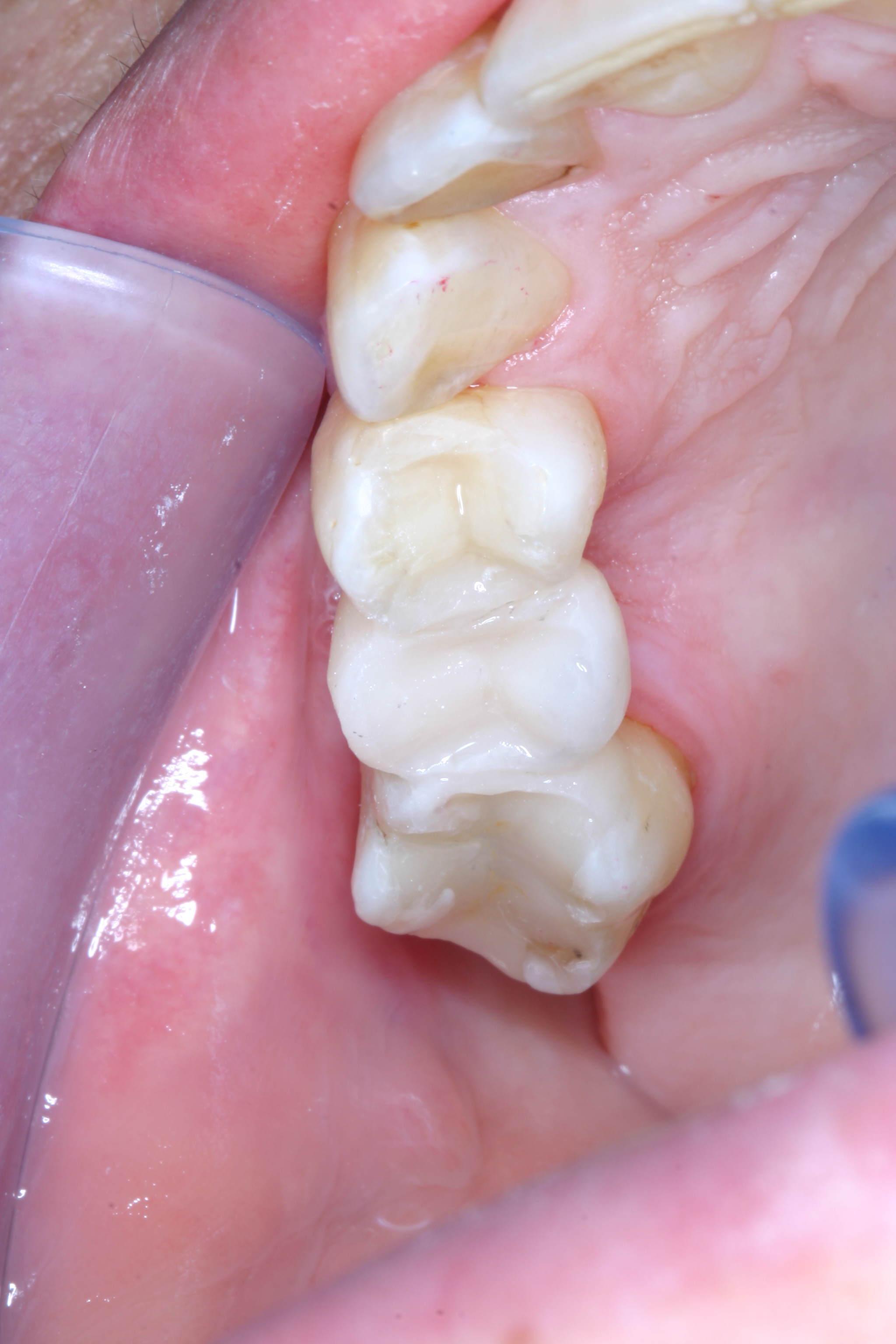 Completed posterior bridge with Dentapreg PFU.
