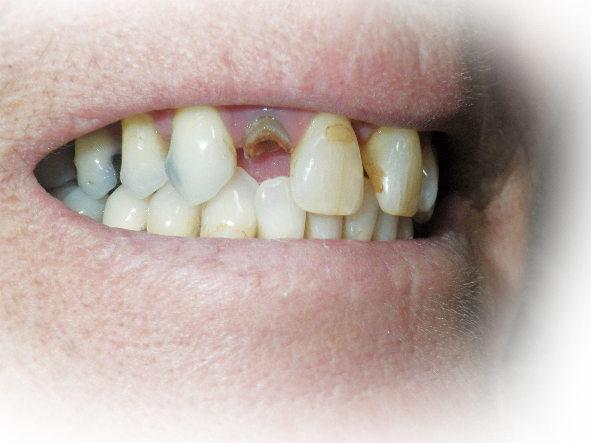 Post and core restoration with Dentapreg PINPost, initial situation.