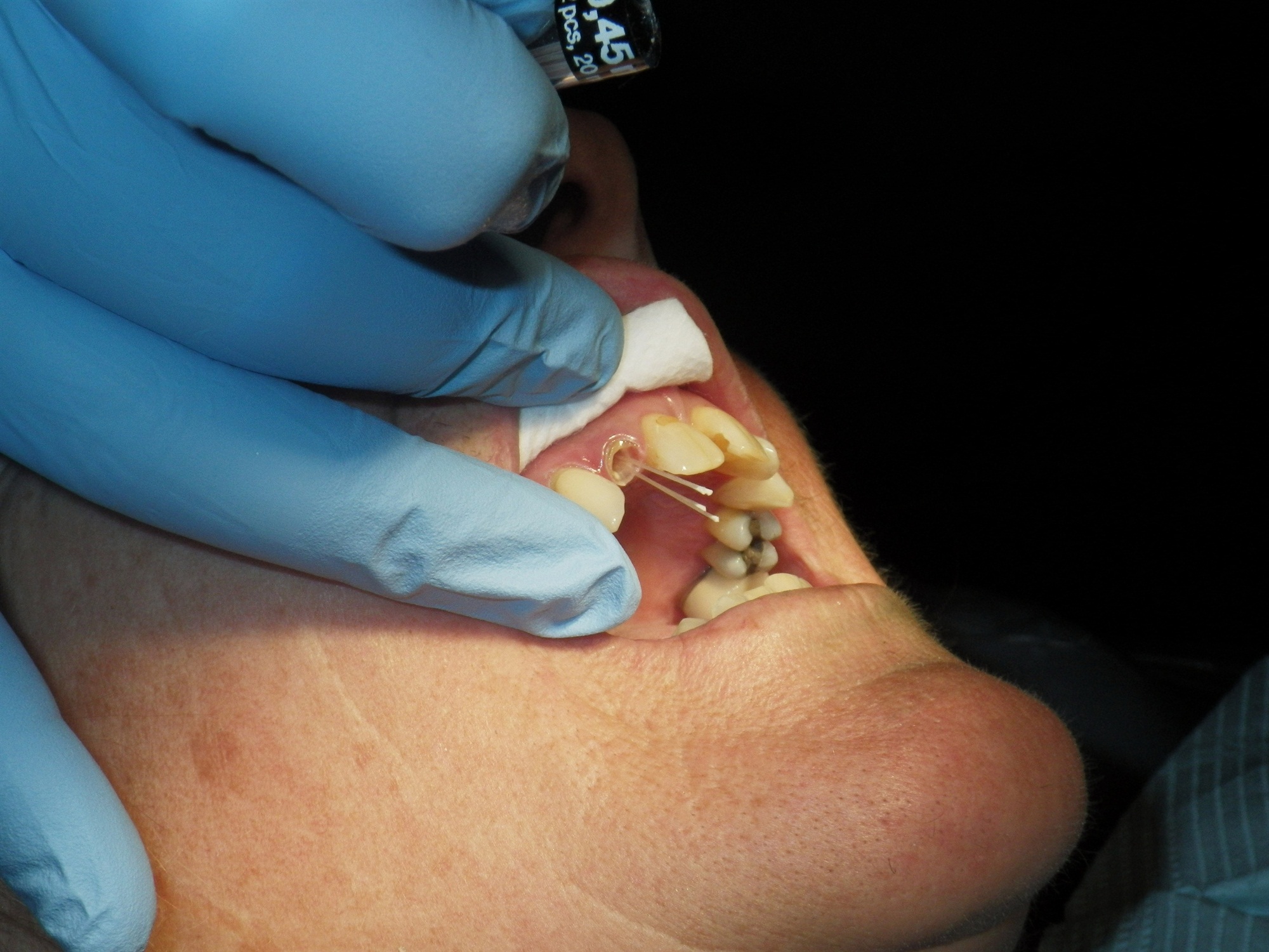 Post and core restoration with Dentapreg PINPost, reinforcement step.